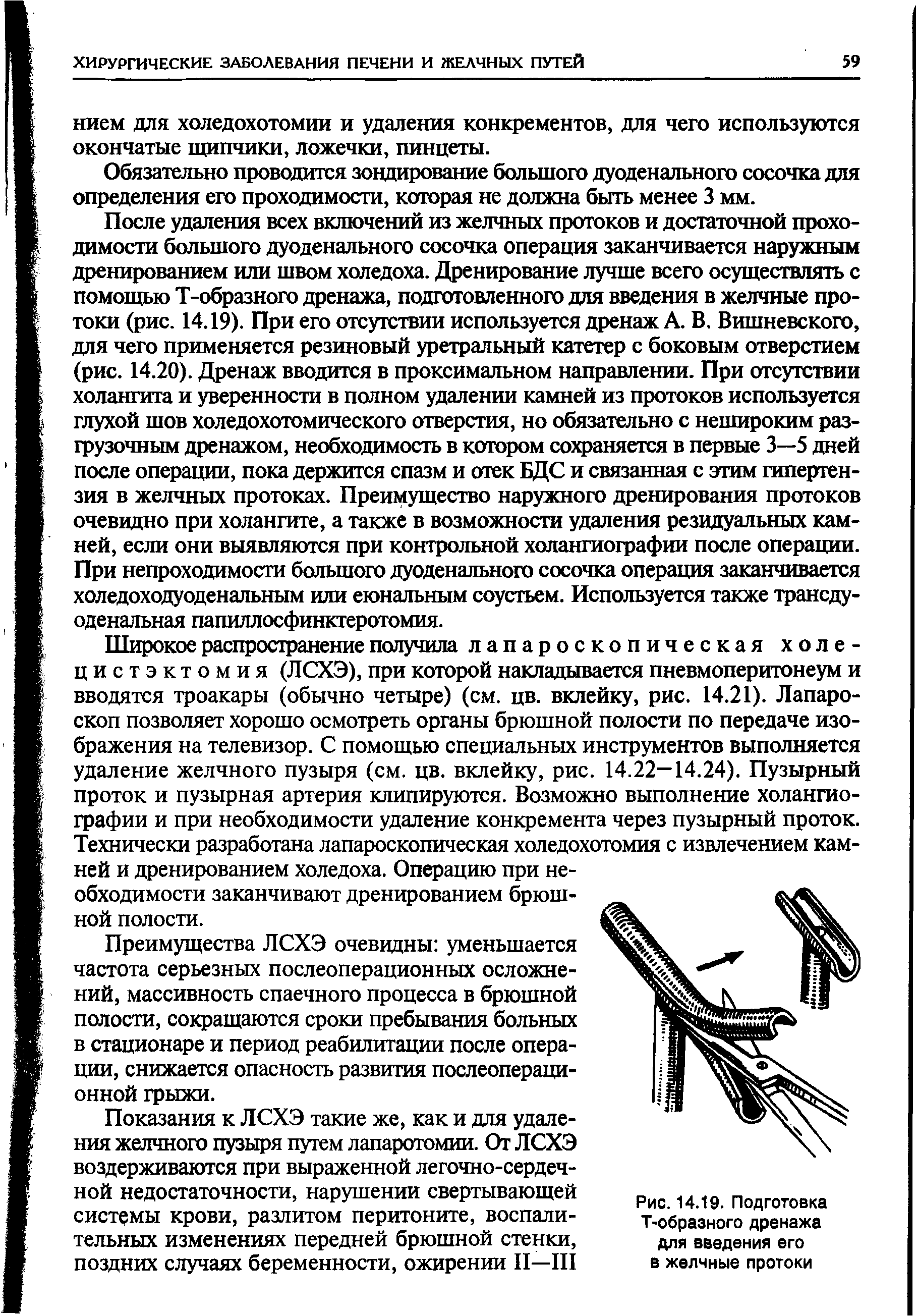 Рис. 14.19. Подготовка Т-образного дренажа для введения его в желчные протоки...