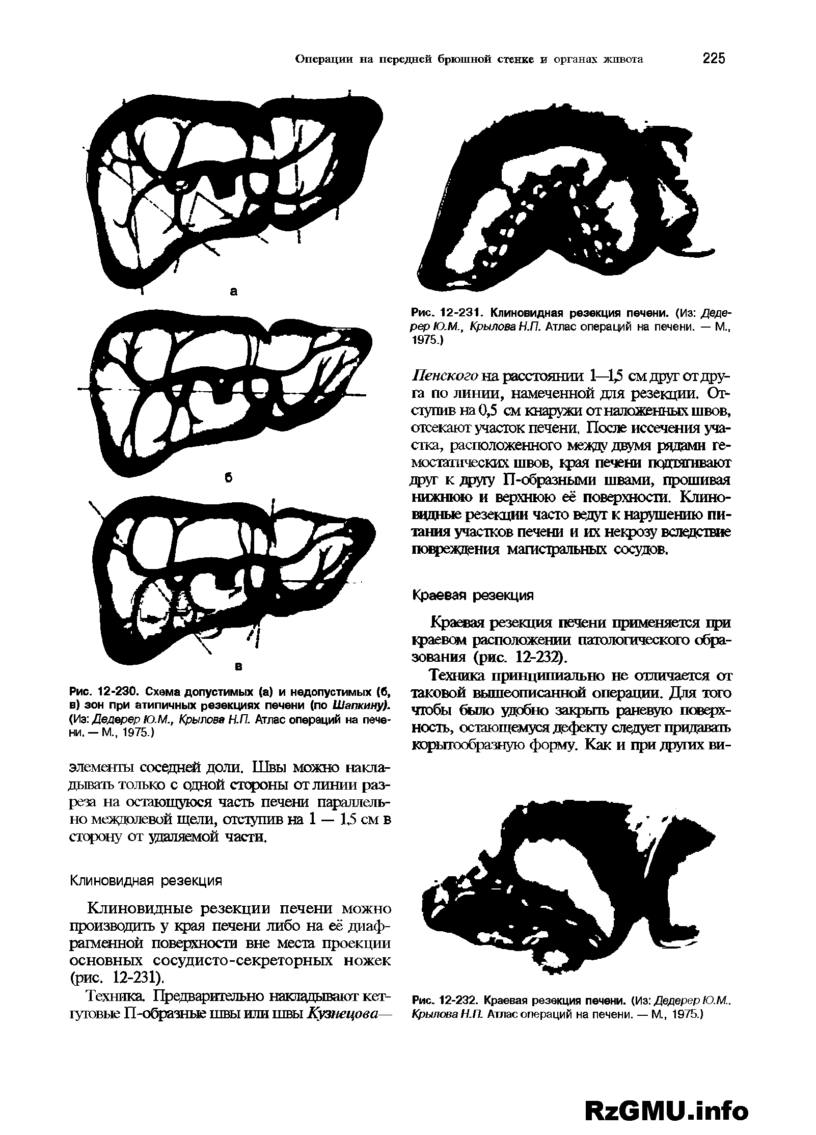 Рис. 12-230. Схема допустимых (а) и недопустимых (б, в) зон при атипичных резекциях печени (по Шапкину). (Иэ ДедерерЮ.М., Крылова Н.П. Атлас операций на печени. — М., 1975.)...