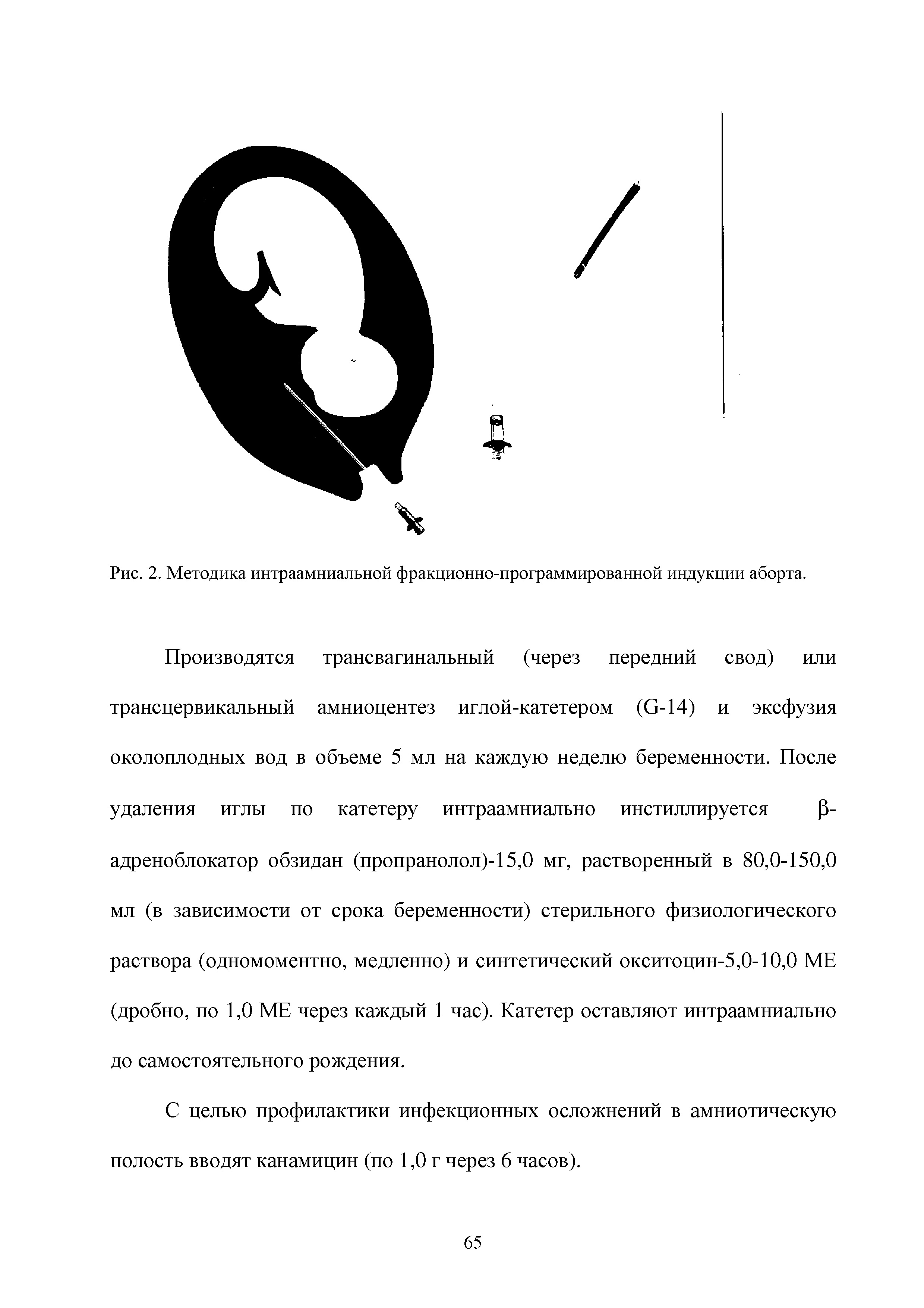 Рис. 2. Методика интраамниальной фракционно-программированной индукции аборта.