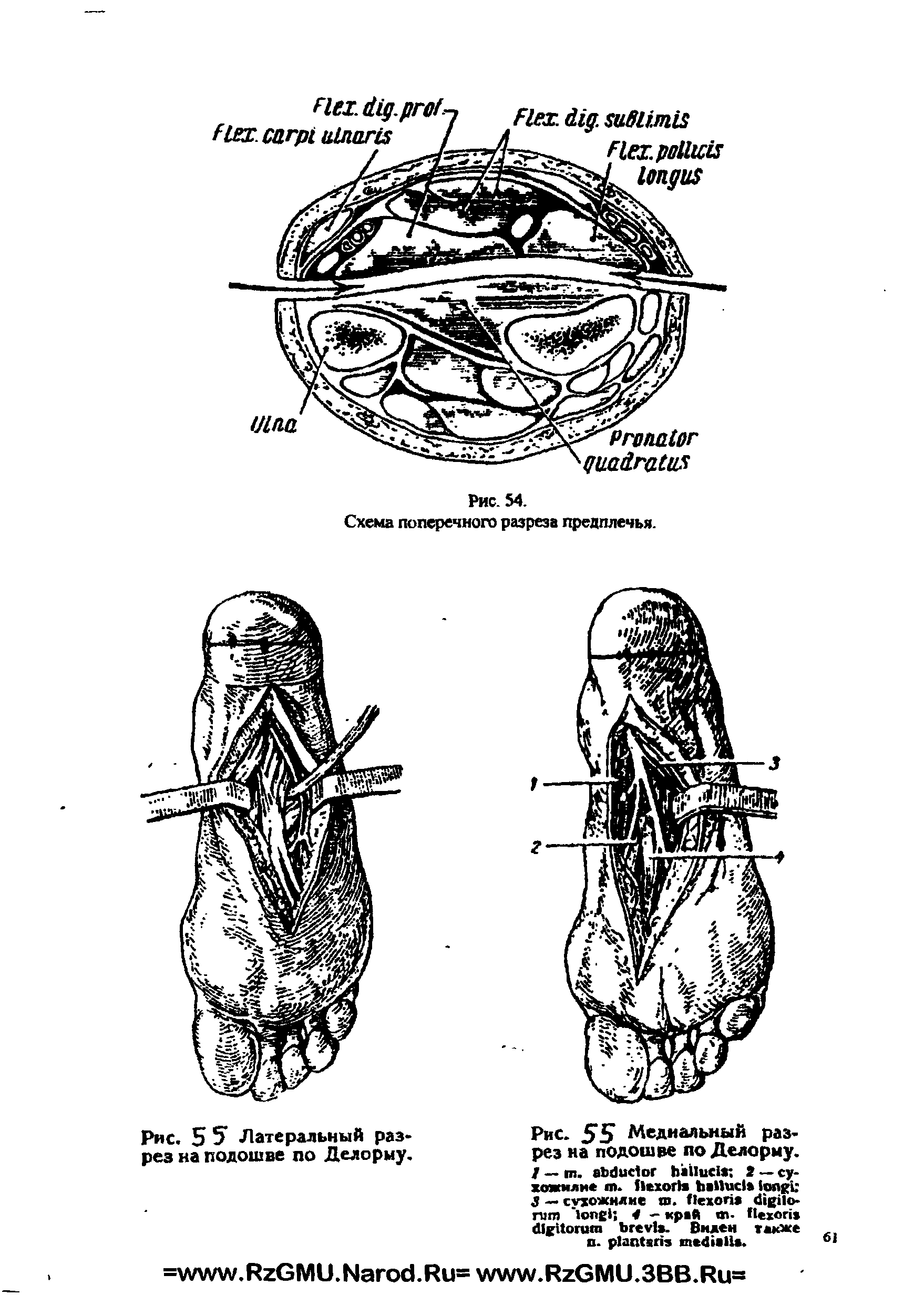Рис. 55 Медиальный разрез на подошве по Делорму. / — п>. 2 — сухожилие <п. 3 — сухожилие ш. - 4 — край - . Виден также и. .