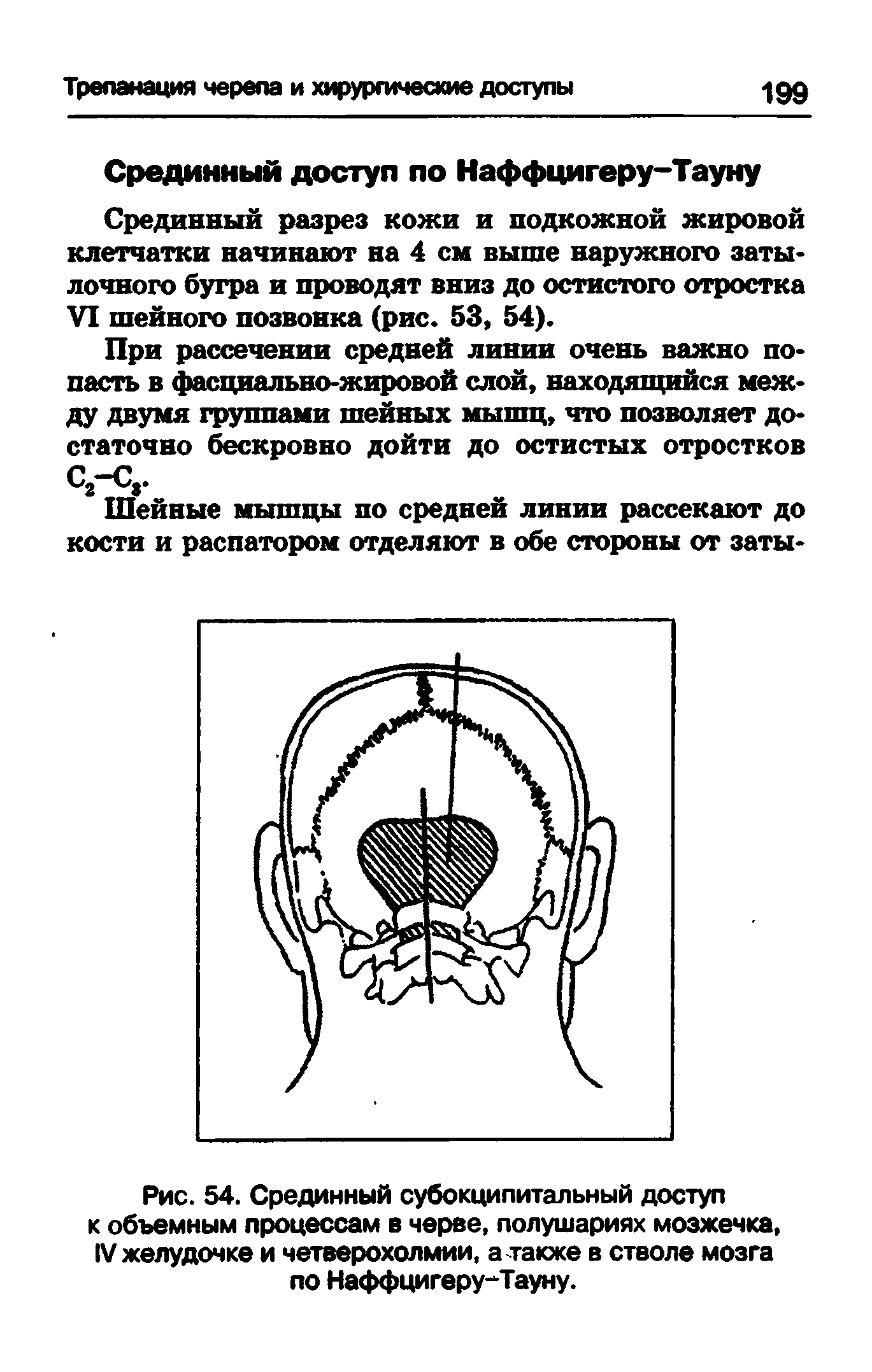 Рис. 54. Срединный субокципитальный доступ к объемным процессам в черве, полушариях мозжечка, IV желудочке и четверохолмии, а также в стволе мозга по Наффцигеру-Тауну.