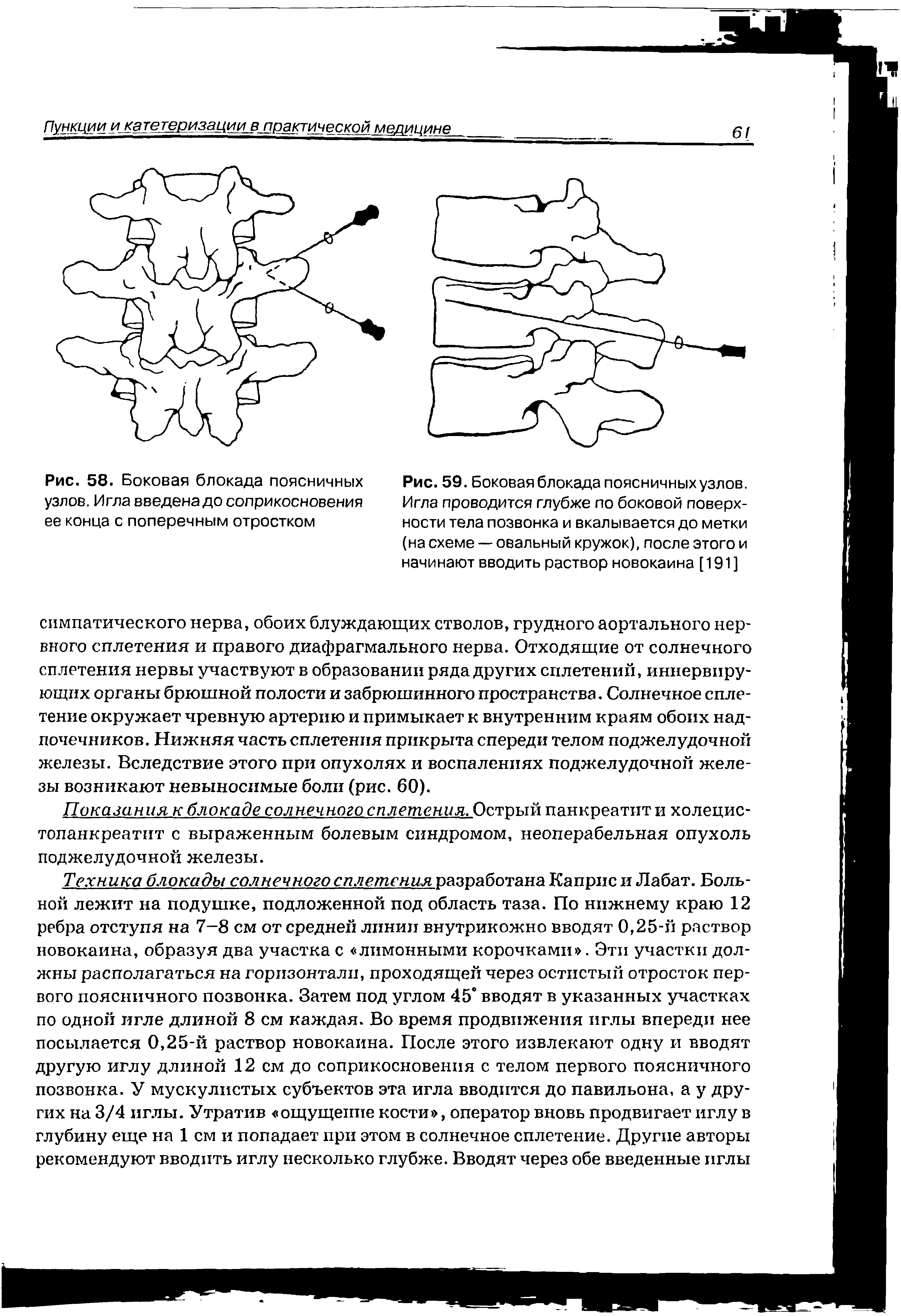 Рис. 59. Боковая блокада поясничных узлов. Игла проводится глубже по боковой поверхности тела позвонка и вкалывается до метки (на схеме — овальный кружок), после этого и начинают вводить раствор новокаина [191]...