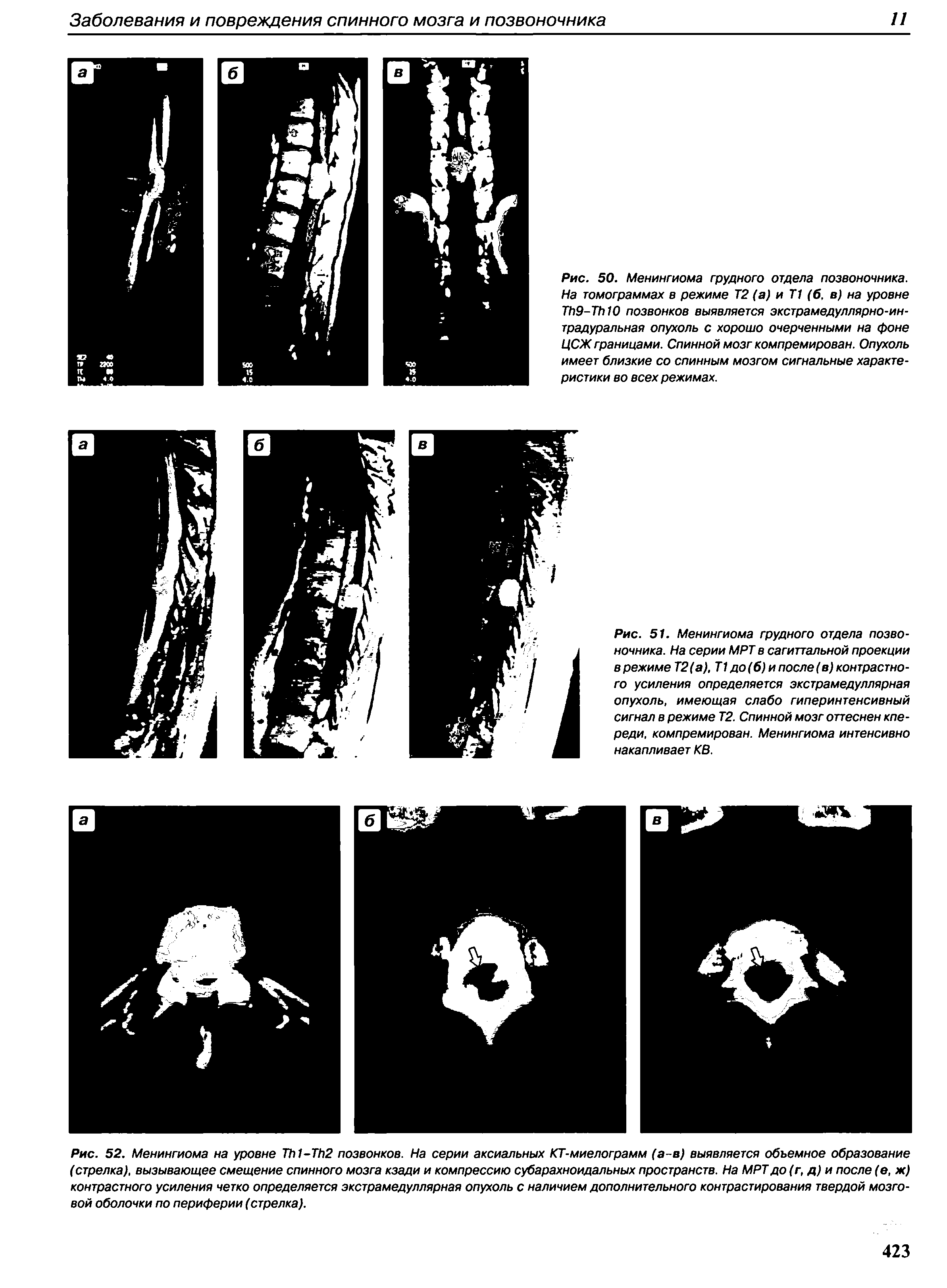 Рис. 51. Менингиома грудного отдела позвоночника. На серии МРТ в сагиттальной проекции врежиме Т2(а), Т1 до(б) ипосле(в) контрастного усиления определяется экстрамедуллярная опухоль, имеющая слабо гиперинтенсивный сигнал в режиме Т2. Спинной мозг оттеснен кпереди, компремирован. Менингиома интенсивно накапливает КВ.