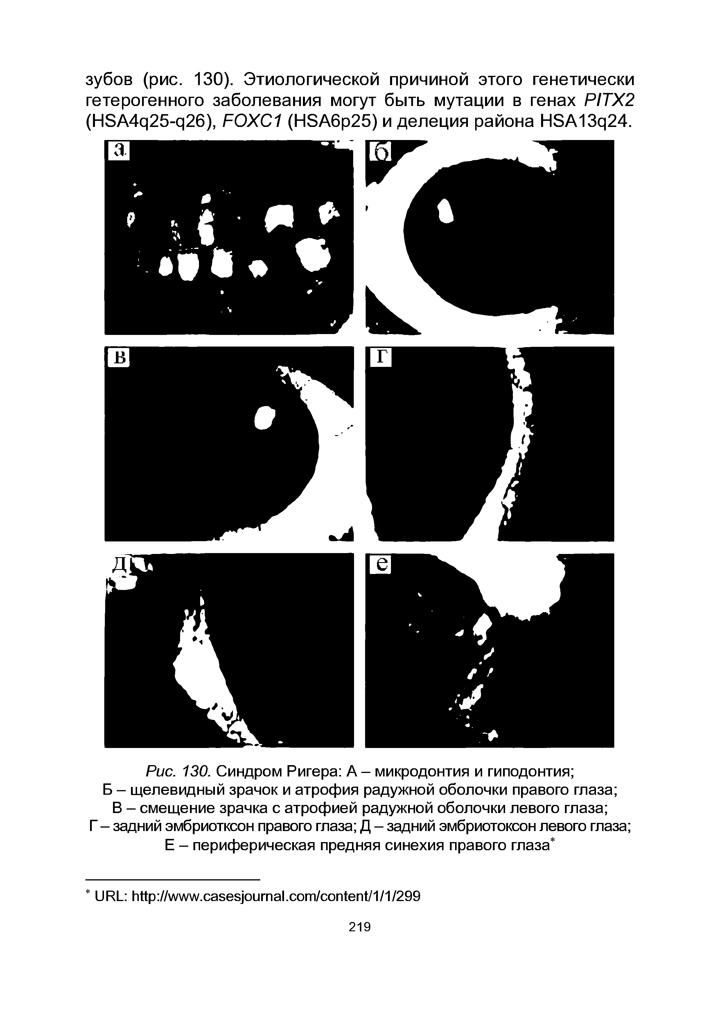 Рис. 130. Синдром Ригера А - микродонтия и гиподонтия Б - щелевидный зрачок и атрофия радужной оболочки правого глаза В - смещение зрачка с атрофией радужной оболочки левого глаза Г - задний эмбриотксон правого глаза Д - задний эмбриотоксон левого глаза Е - периферическая предняя синехия правого глаза ...