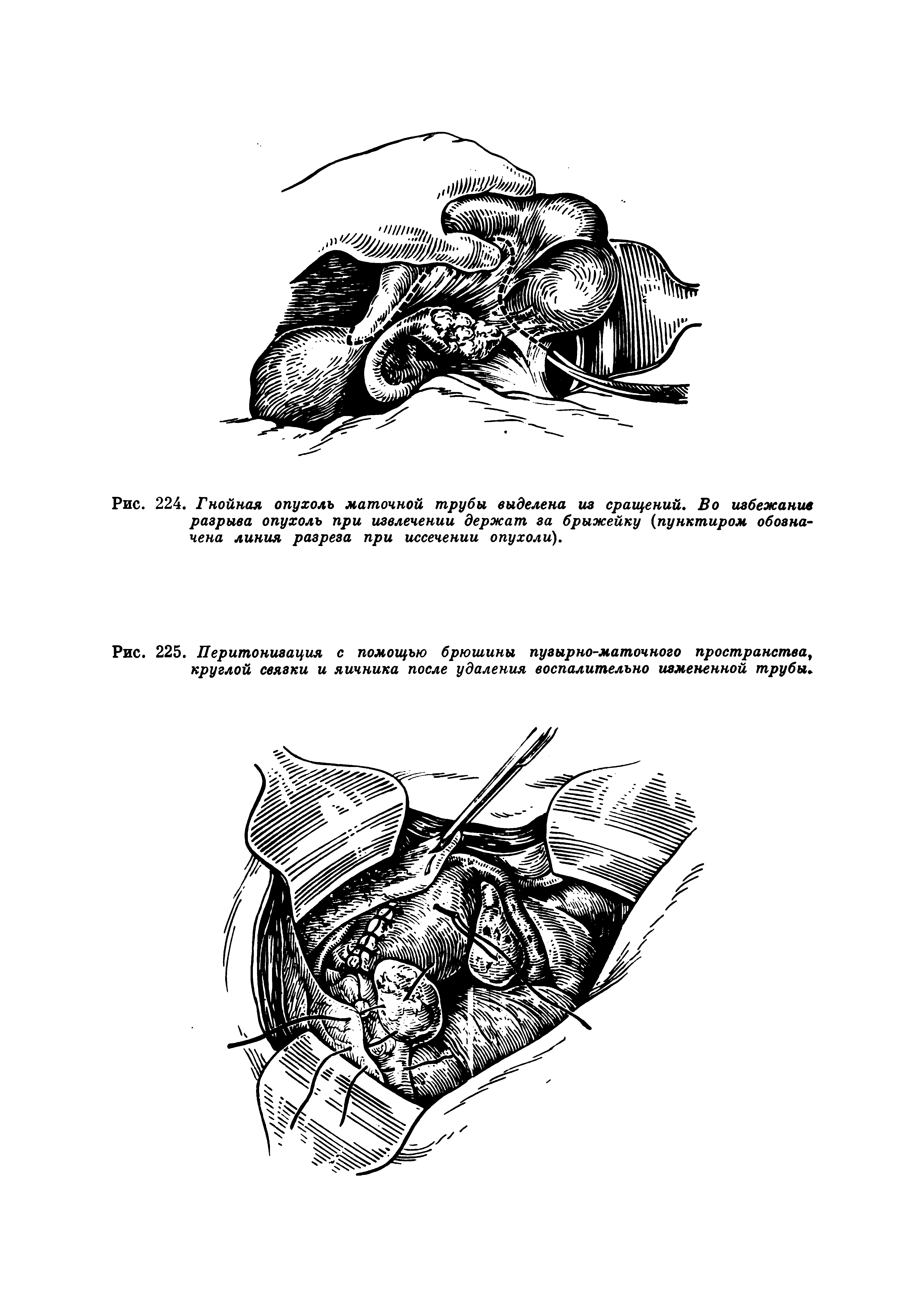 Рис. 225. Перитонизация с помощью брюшины пузырно-маточного пространства, круглой связки и яичника после удаления воспалительно измененной трубы-...