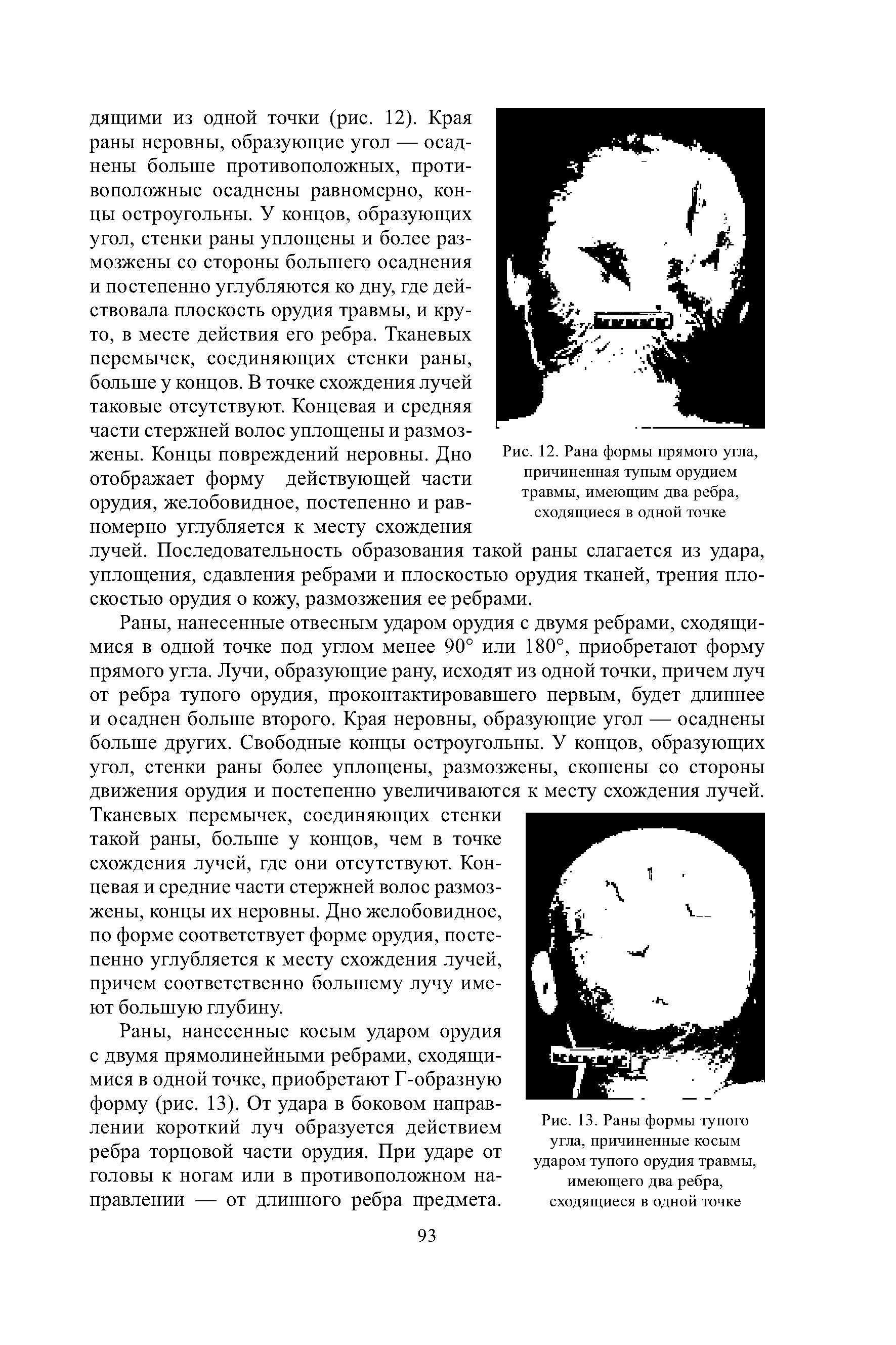 Рис. 12. Рана формы прямого угла, причиненная тупым орудием травмы, имеющим два ребра, сходящиеся в одной точке...