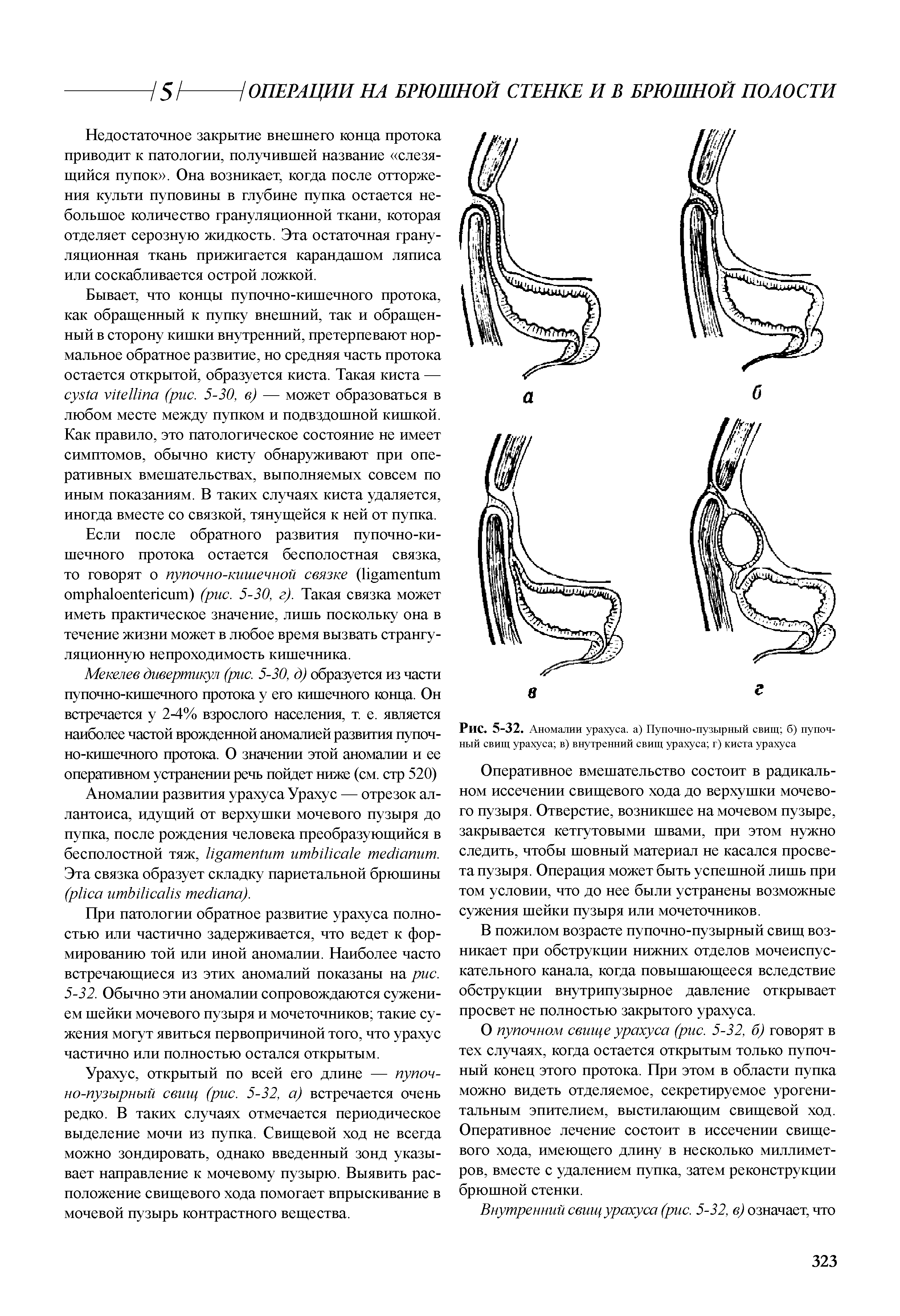 Рис. 5-32. Аномалии урахуса, а) Пупочно-пузырный свищ б) пупочный свищ урахуса в) внутренний свищ урахуса г) киста урахуса...
