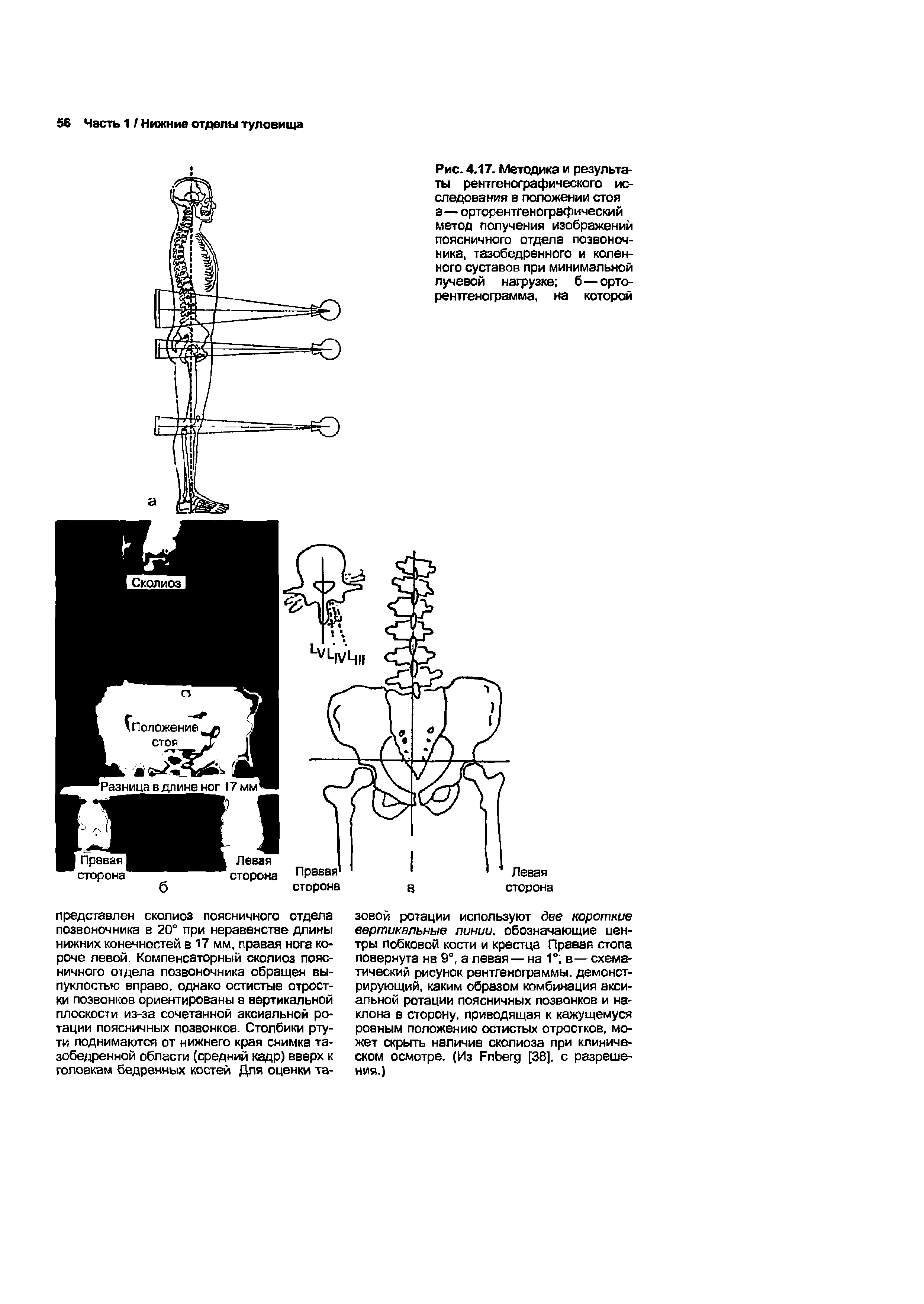 Рис. 4.17. Методика и результаты рентгенографического исследования в положении стоя а—орторентгенографический метод получения изображений поясничного отдела позвоночника, тазобедренного и коленного суставов при минимальной лучевой нагрузке б—орторентгенограмма, на которой...