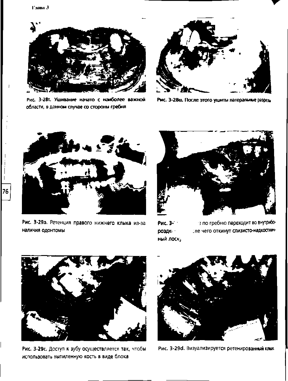 Рис. 3-29с. Доступ к зубу осуществляется так, чтобы использовать выпиленную кость в виде блока...