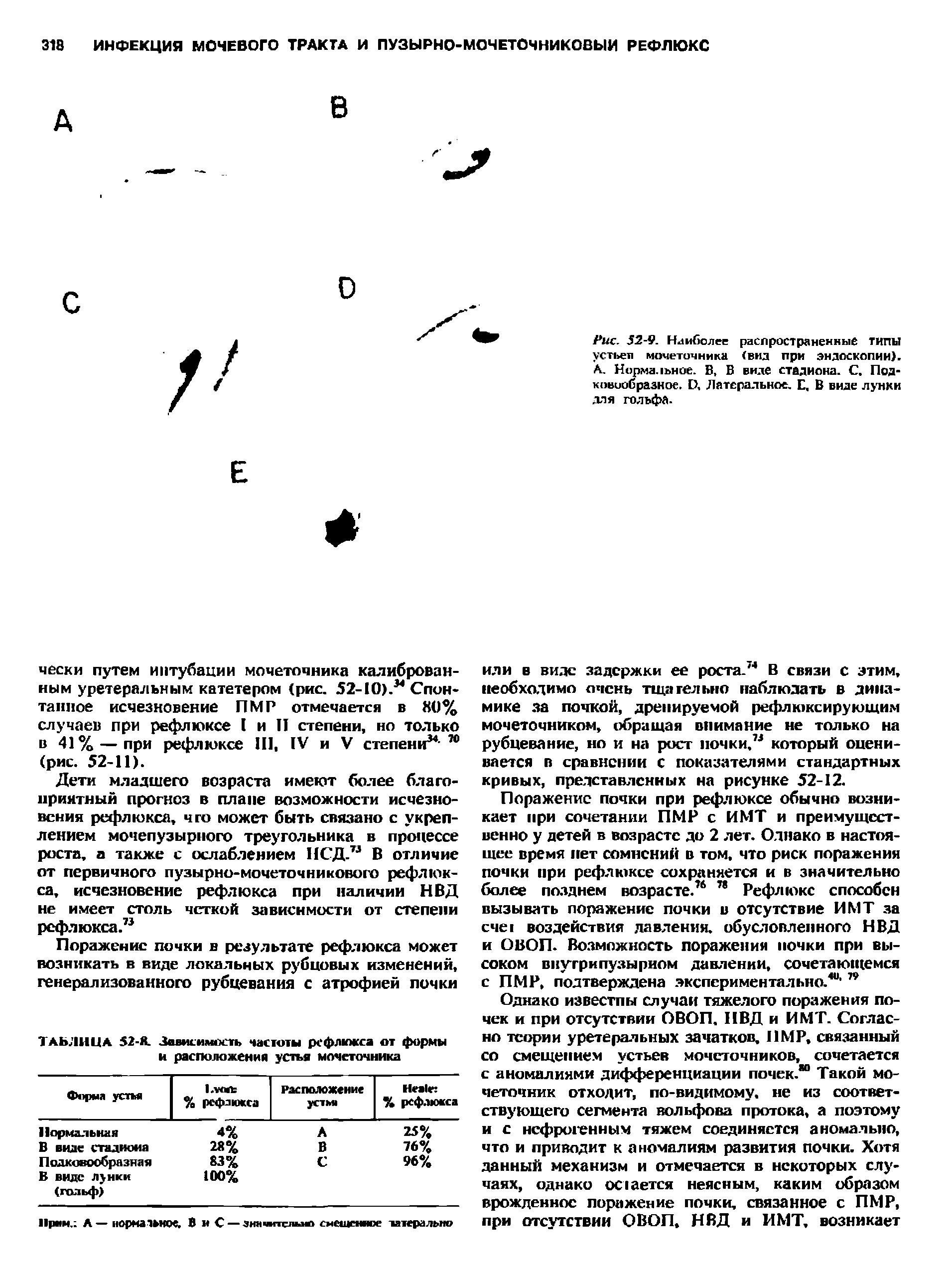 Рис. 52-9. Наиболее распространенные ТИПЫ уст1>ет1 мочеточника (вид при эндоскопии). А. Нормальное. В, В виде стадиона. С. Под ковиибразное. О, Латеральное. Е, В виде лунки для гольфа.