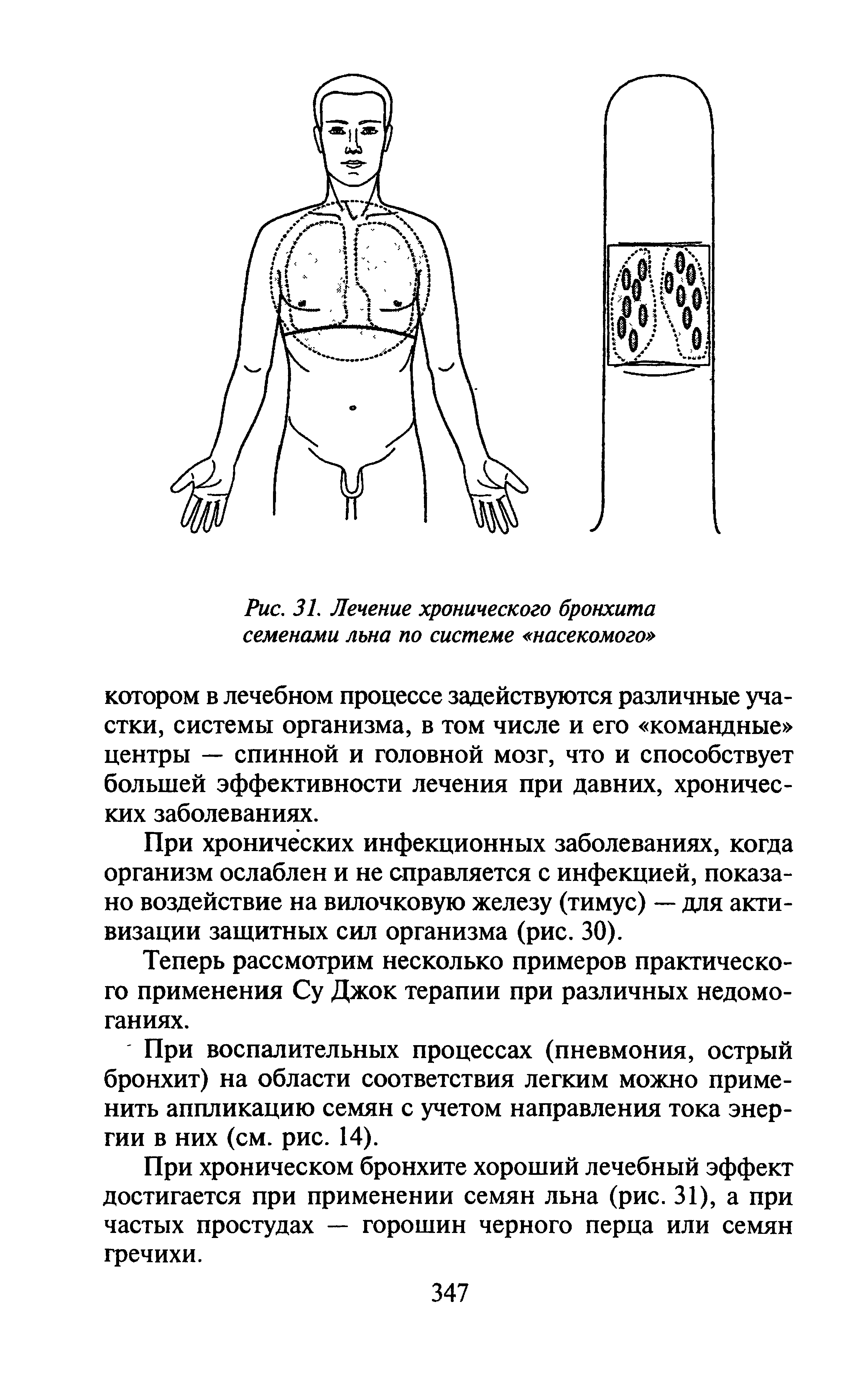 Рис. 31. Лечение хронического бронхита семенами льна по системе насекомого ...