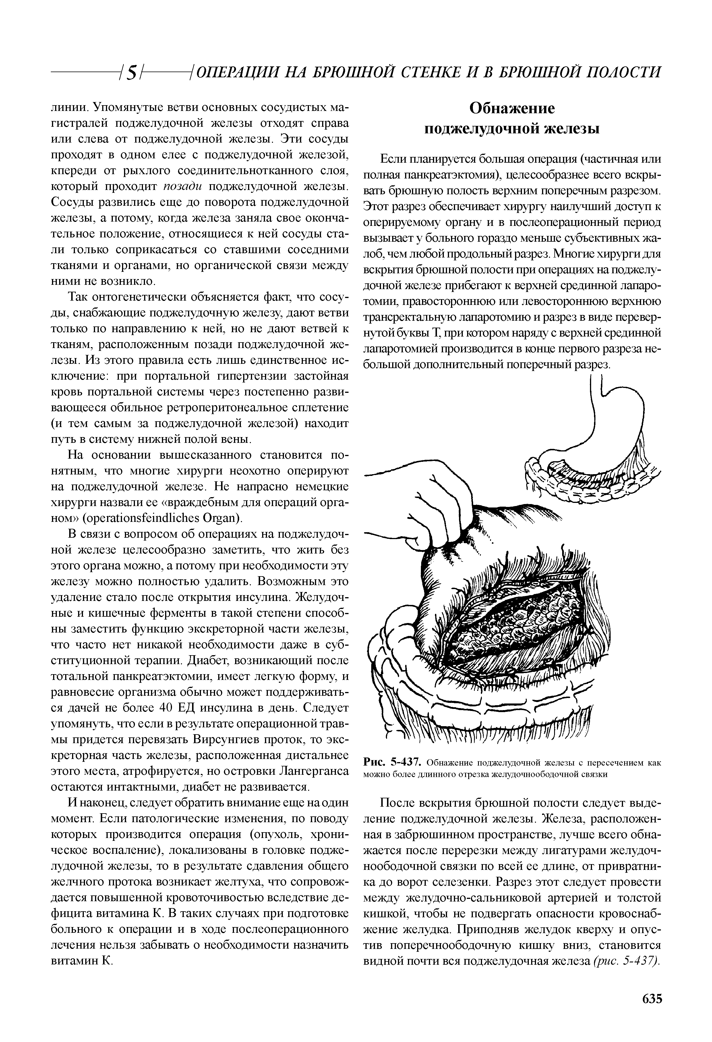 Рис. 5-437. Обнажение поджелудочной железы с пересечением как можно более длинного отрезка желудочноободочной связки...