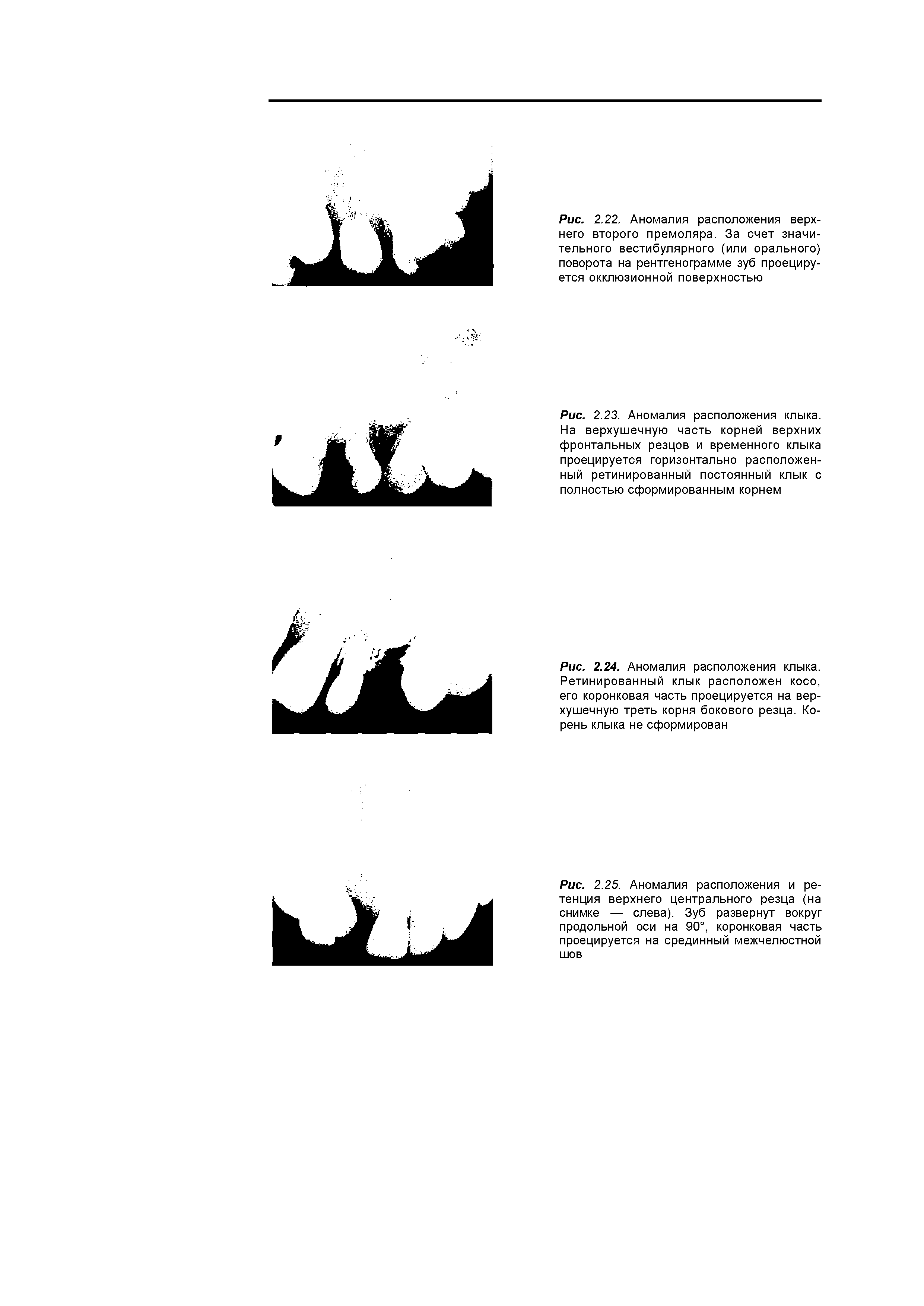 Рис. 2.24. Аномалия расположения клыка Ретинированный клык расположен косо, его коронковая часть проецируется на верхушечную треть корня бокового резца. Корень клыка не сформирован...