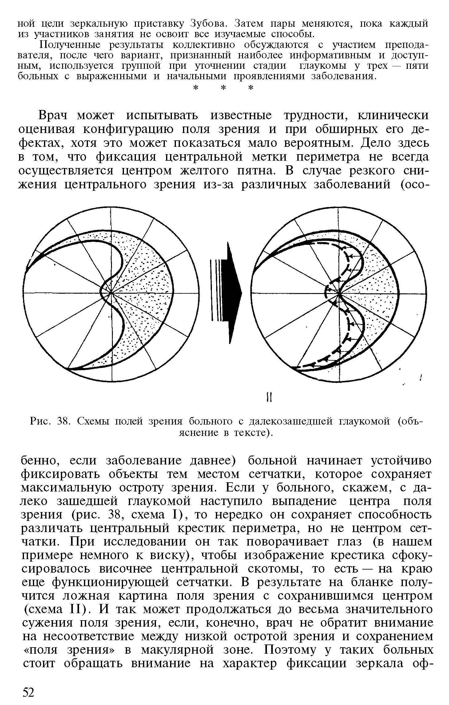 Рис. 38. Схемы полей зрения больного с далекозашедшей глаукомой (объяснение в тексте).