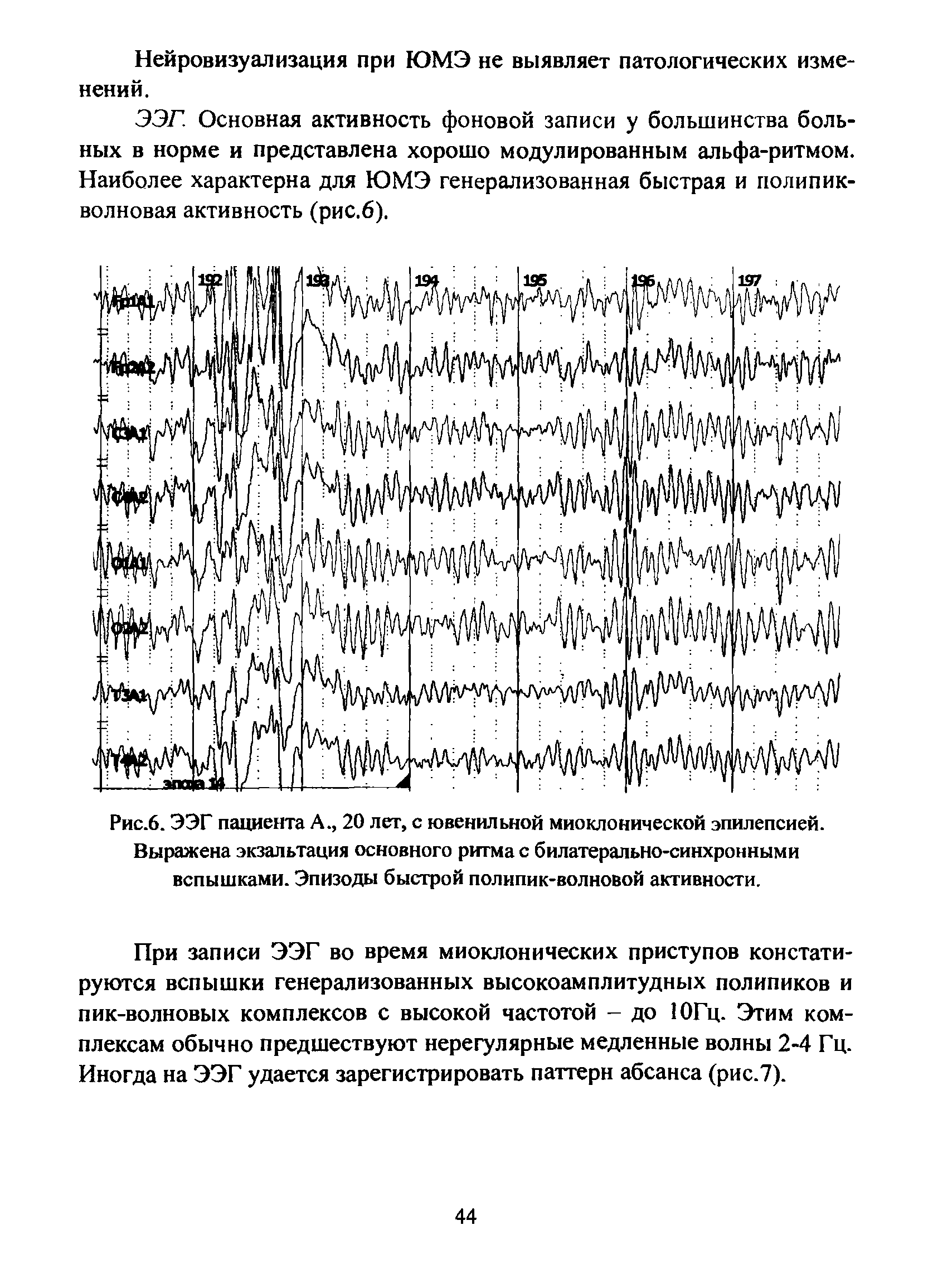 Рис.6. ЭЭГ пациента А., 20 лет, с ювенильной миоклонической эпилепсией. Выражена экзальтация основного ритма с билатерально-синхронными вспышками. Эпизоды быстрой полипик-волновой активности.