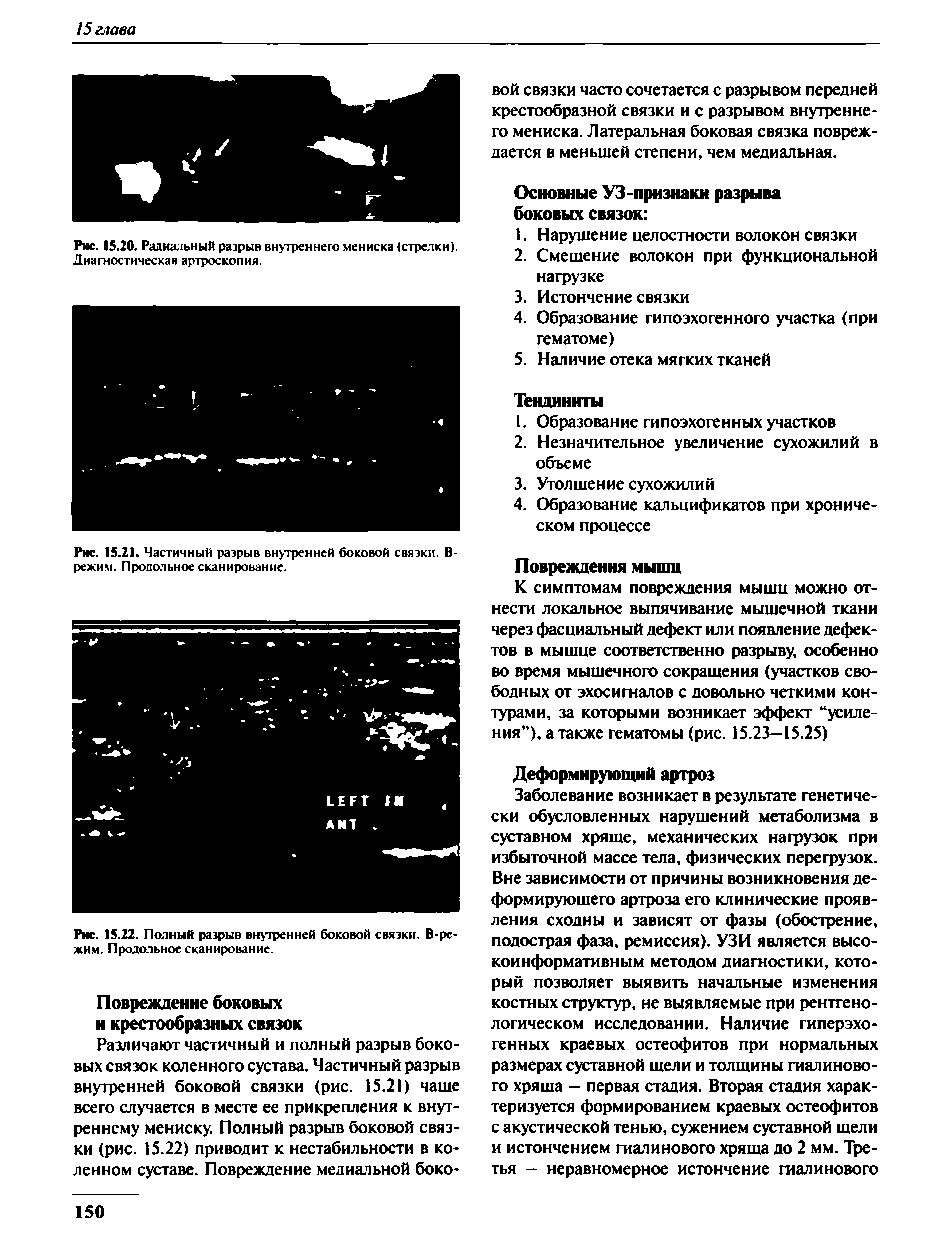 Рис. 15.21. Частичный разрыв внутренней боковой связки. В-режим. Продольное сканирование.