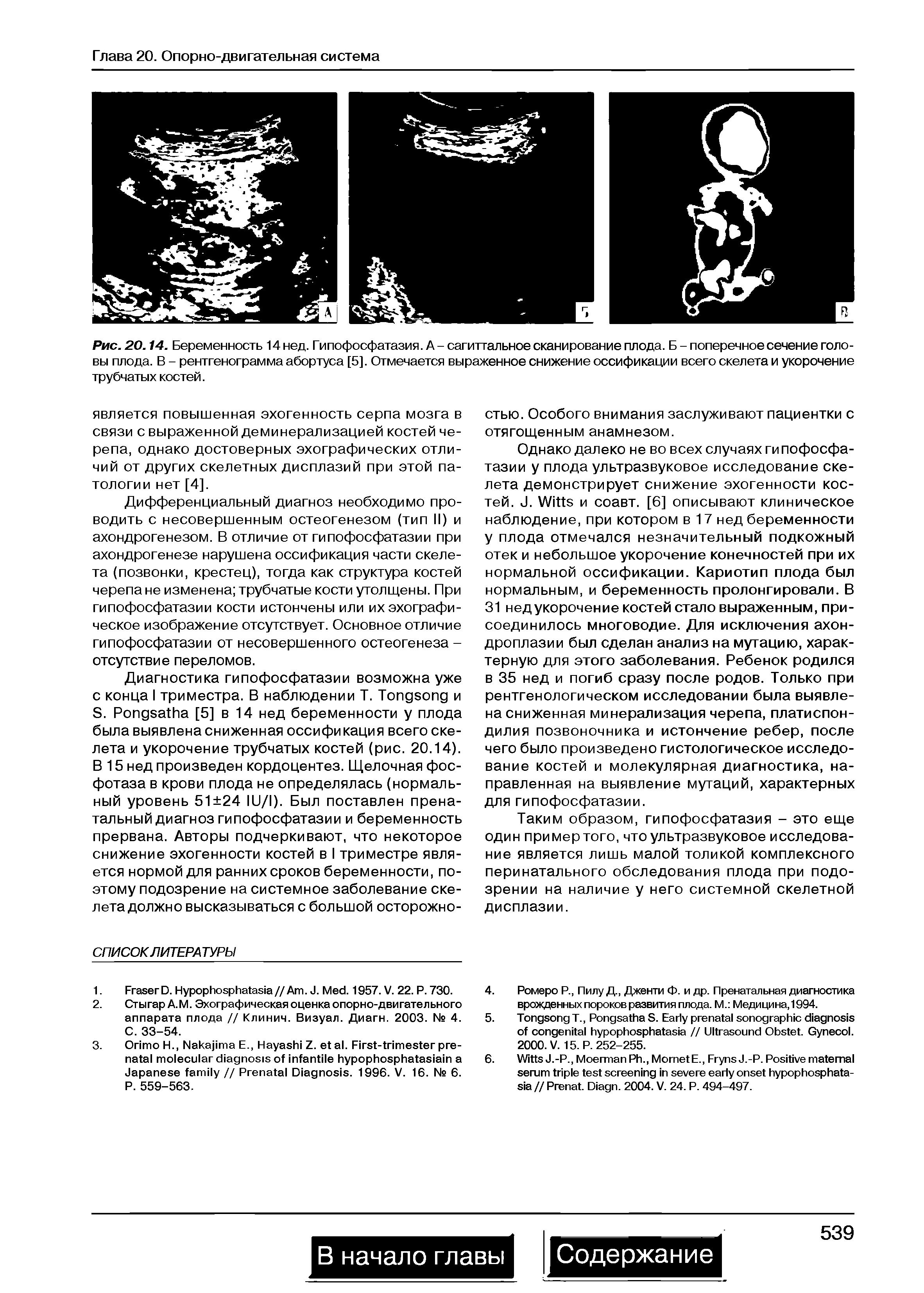 Рис. 20.14. Беременность 14 нед. Гипофосфатазия. А - сагиттальное сканирование плода. Б - поперечное сечение головы плода. В - рентгенограмма абортуса [5]. Отмечается выраженное снижение оссификации всего скелета и укорочение трубчатых костей.