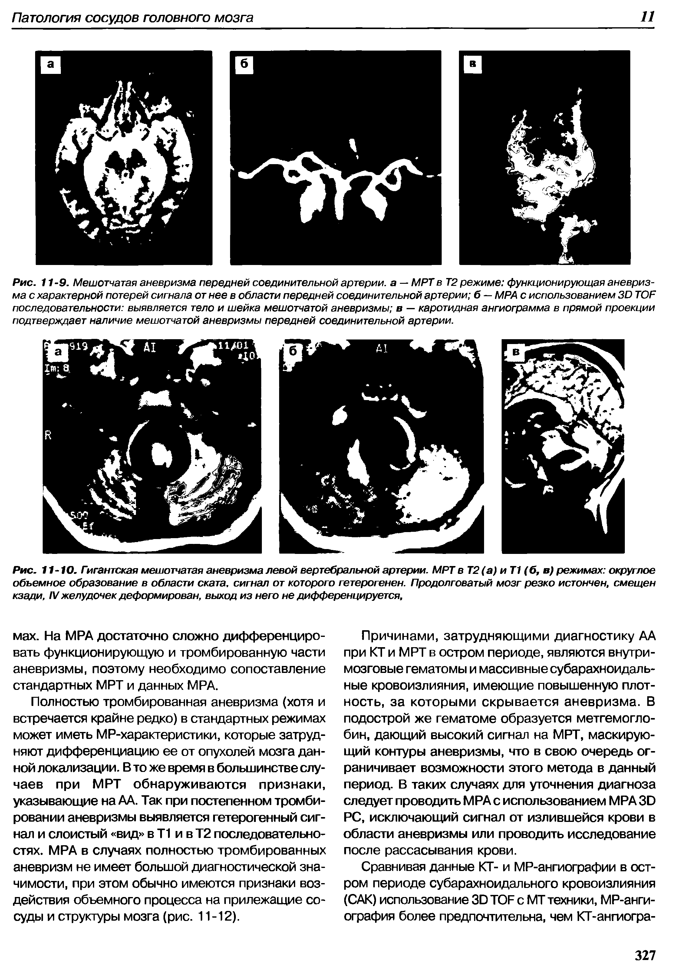 Рис. 11-10. Гигантская мешотчатая аневризма левой вертебральной артерии. МРТ в Т2(а) иТ1 (б, в) режимах округлое объемное образование в области ската, сигнал от которого гетерогенен. Продолговатый мозг резко истончен, смещен кзади, IV желудочек деформирован, выход из него не дифференцируется.