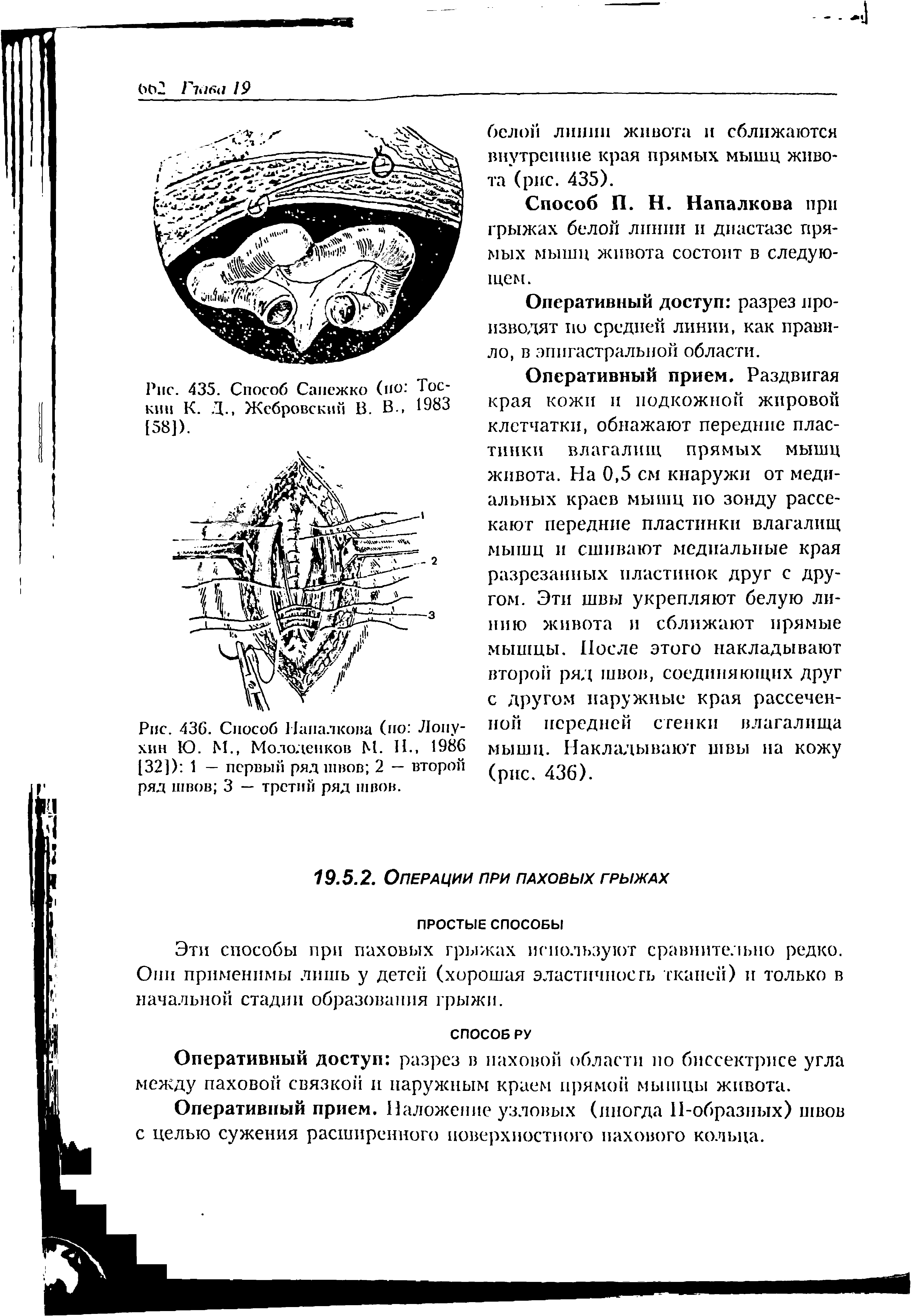 Рис. 436. Способ Напалкова (по Лопухин Ю. М., Мололенков М. Н. 1986 [32]) 1 — первый ряд швов 2 — второй ряд швов 3 — третий ряд швов.