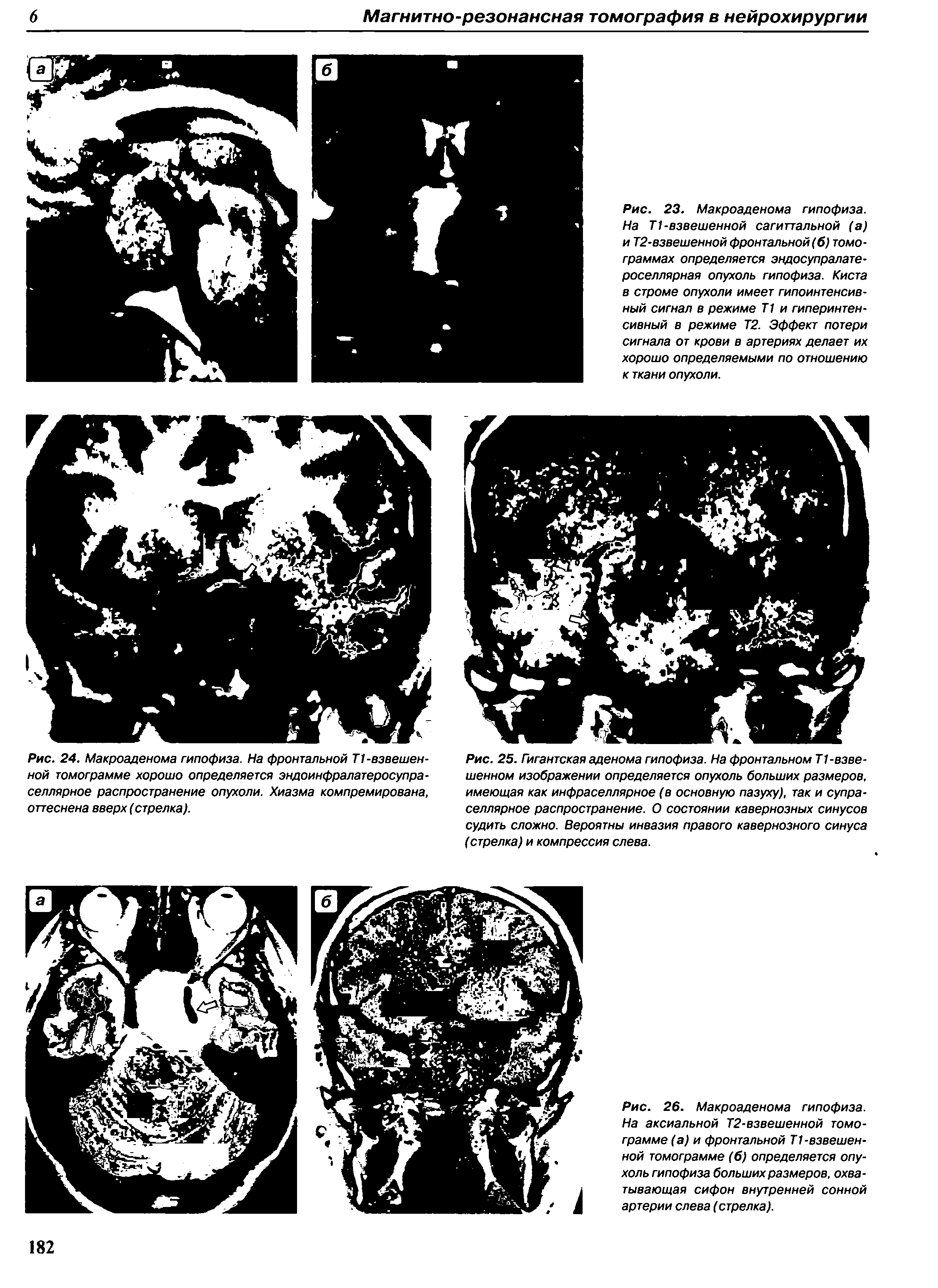 Рис. 24. Макроаденома гипофиза. На фронтальной Т1-взвешенной томограмме хорошо определяется эндоинфралатеросупра-селлярное распространение опухоли. Хиазма компремирована, оттеснена вверх (стрелка).