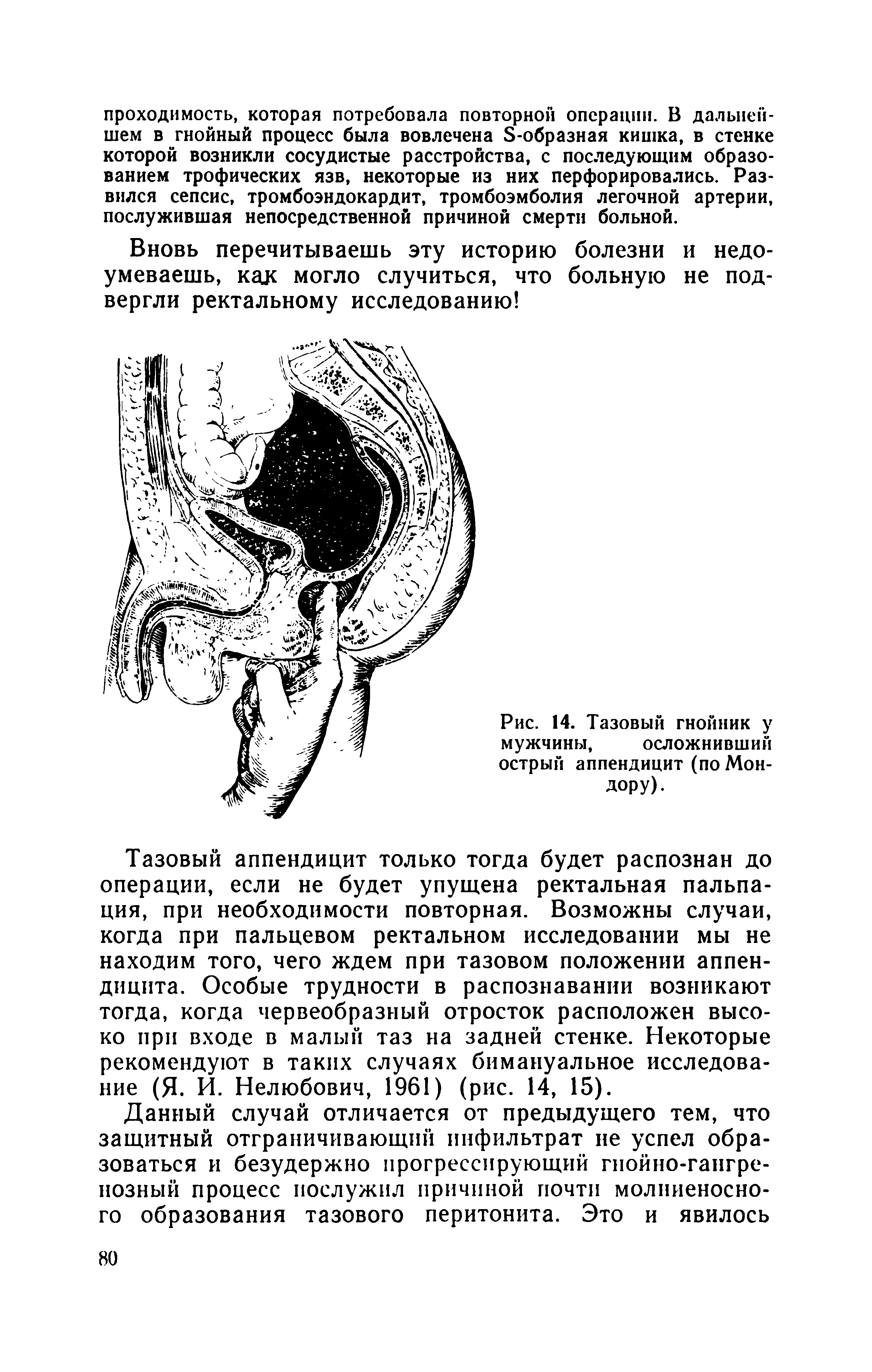 Рис. 14. Тазовый гнойник у мужчины, осложнивший острый аппендицит (по Мон-ДОРУ) ...