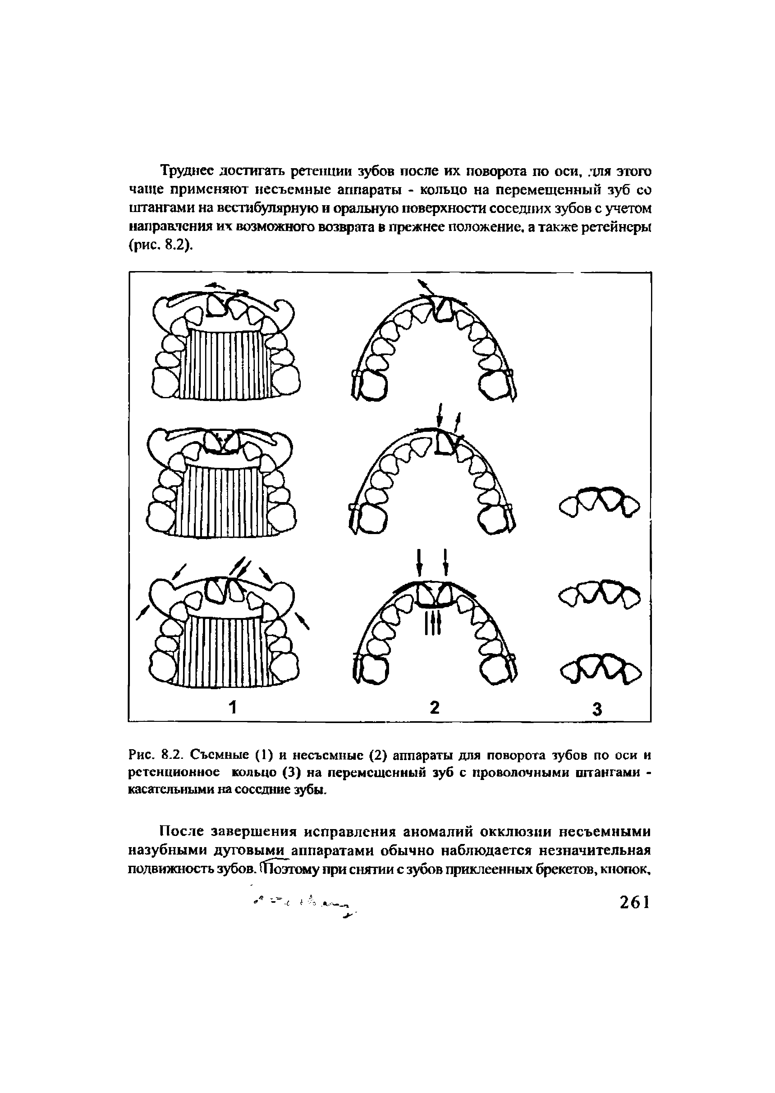 Рис. 8.2. Съемные (1) и несъемные (2) аппараты для поворота зубов по оси и ретенционное кольцо (3) на перемешенный зуб с проволочными штангами -касательными на соседние зубы.