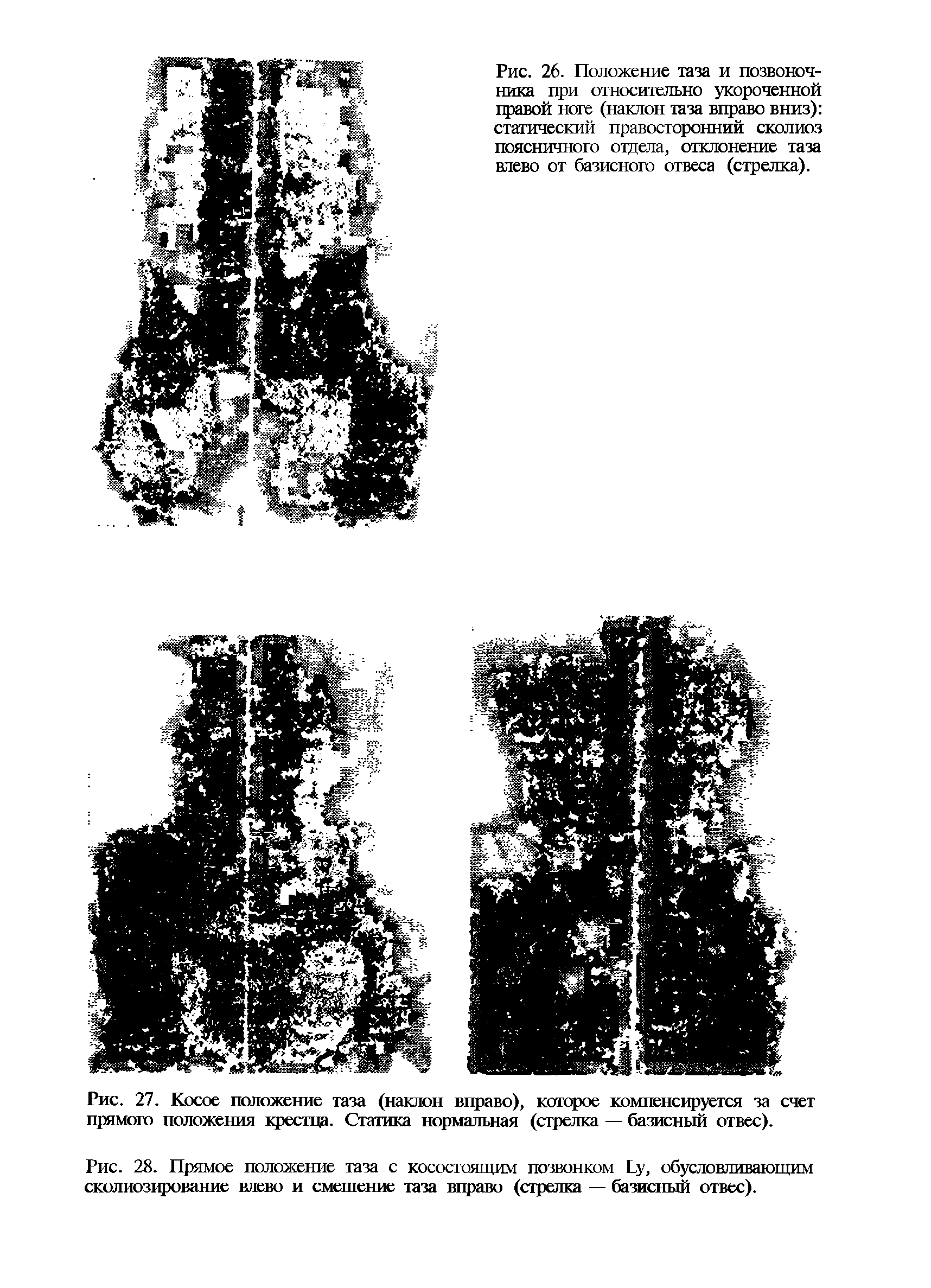 Рис. 27. Косое положение таза (наклон вправо), которое компенсируется за счет прямого положения крестца. Статика нормальная (стрелка — базисный отвес).