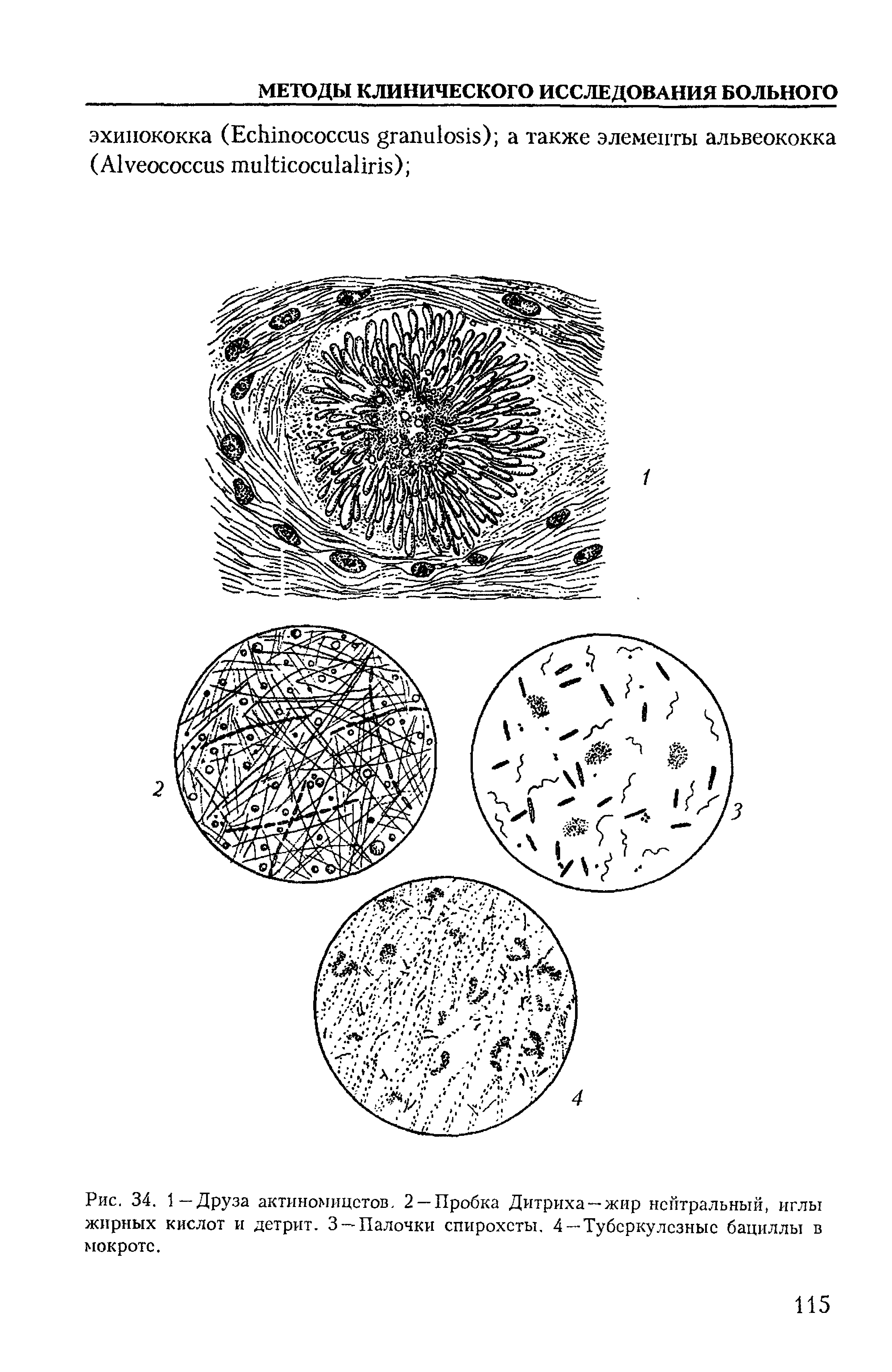 Рис. 34. 1-Друза актиномицстов. 2-Пробка Дитриха-жир нейтральный, иглы жирных кислот и детрит. 3 —Палочки спирохеты, 4 —Туберкулезные бациллы в мокроте.