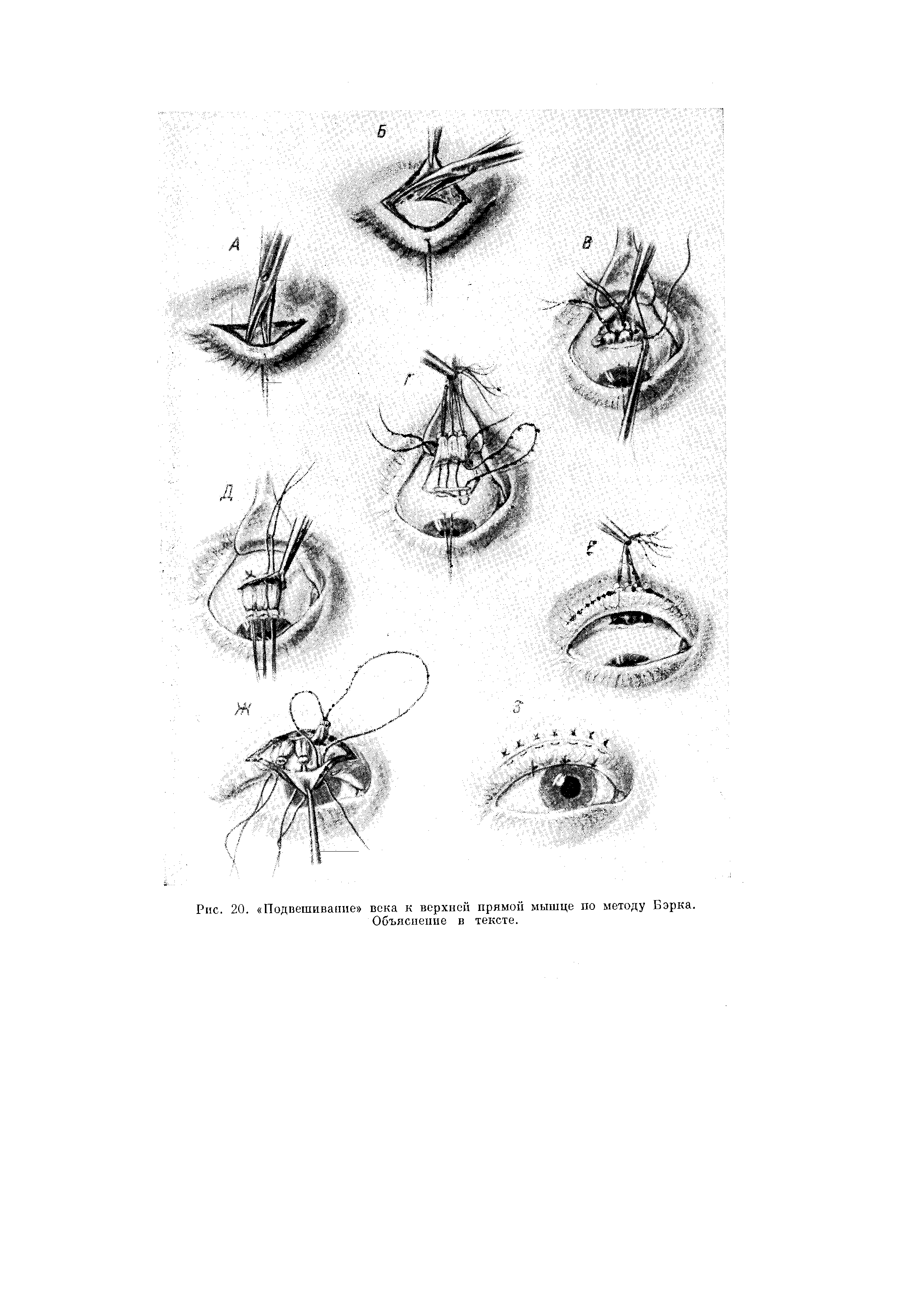 Рис. 20. Подвешивание века к верхней прямой мышце по методу Бэрка. Объяснение в тексте.