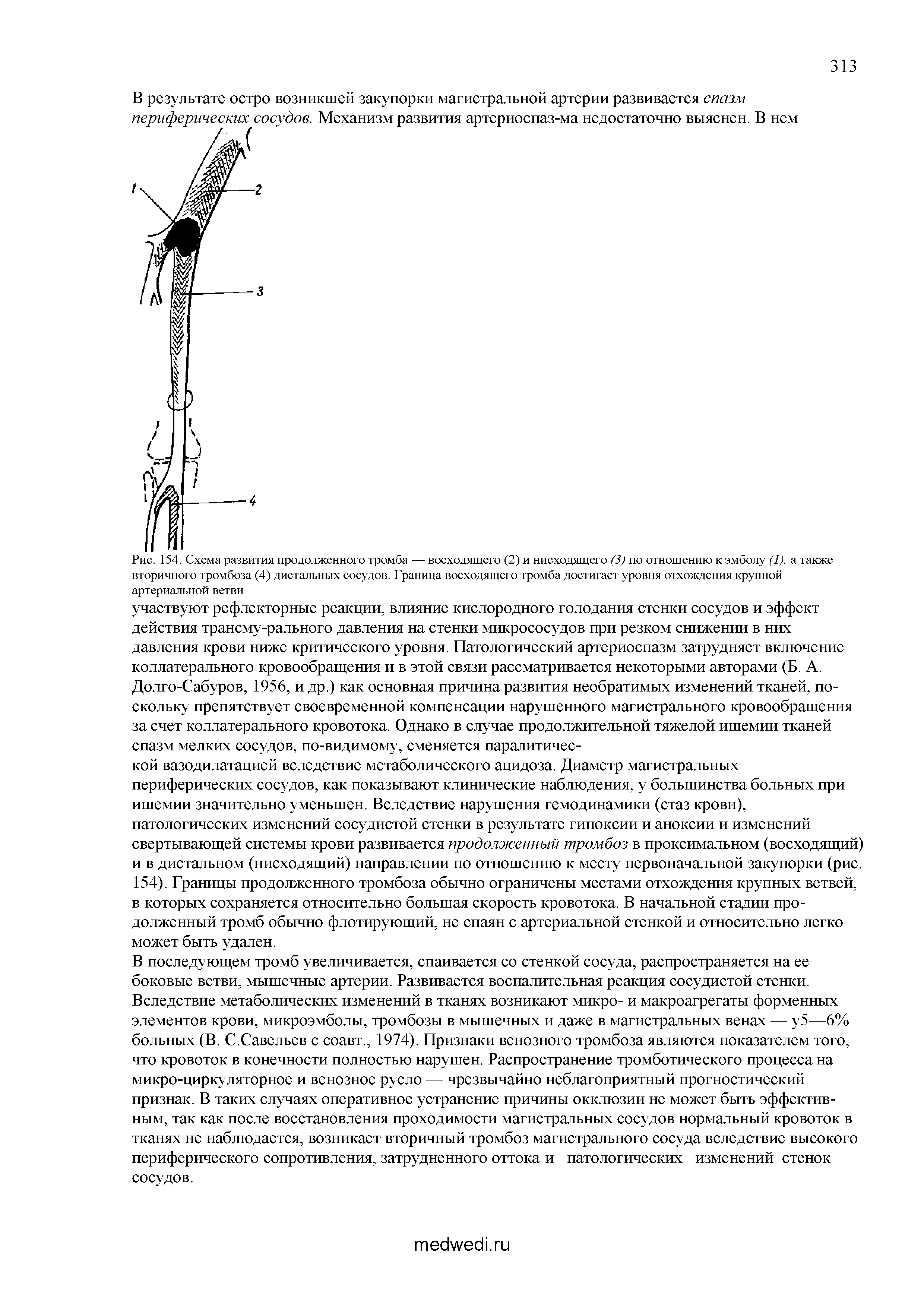 Рис. 154. Схема развития продолженного тромба — восходящего (2) и нисходящего (3) по отношению к эмболу (1), а также вторичного тромбоза (4) дистальных сосудов. Граница восходящего тромба достигает уровня отхождения крупной артериальной ветви...