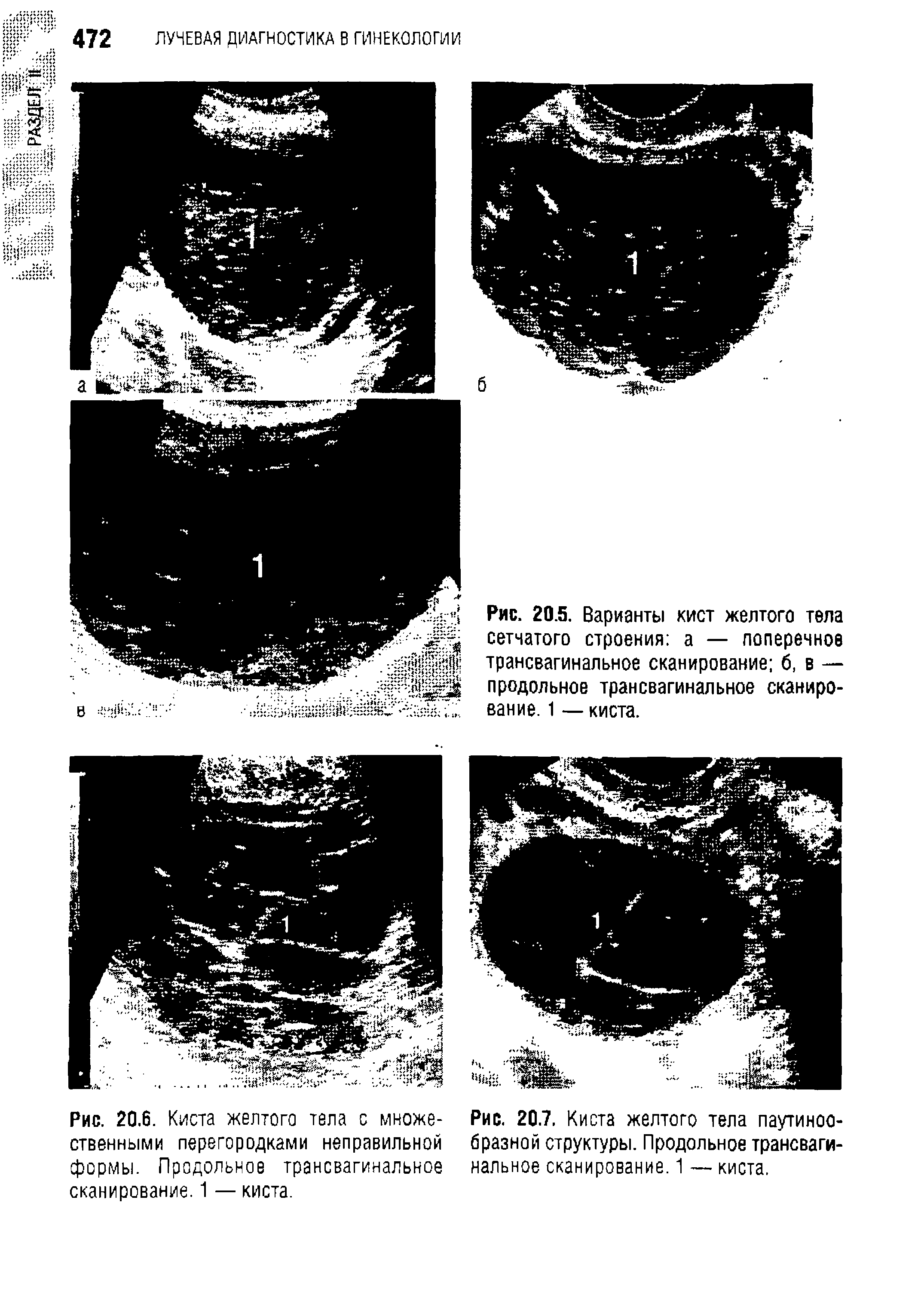 Рис. 20.5. Варианты кист желтого тела сетчатого строения а — поперечное трансвагинальное сканирование б, в — продольное трансвагинальное сканирование. 1 — киста.