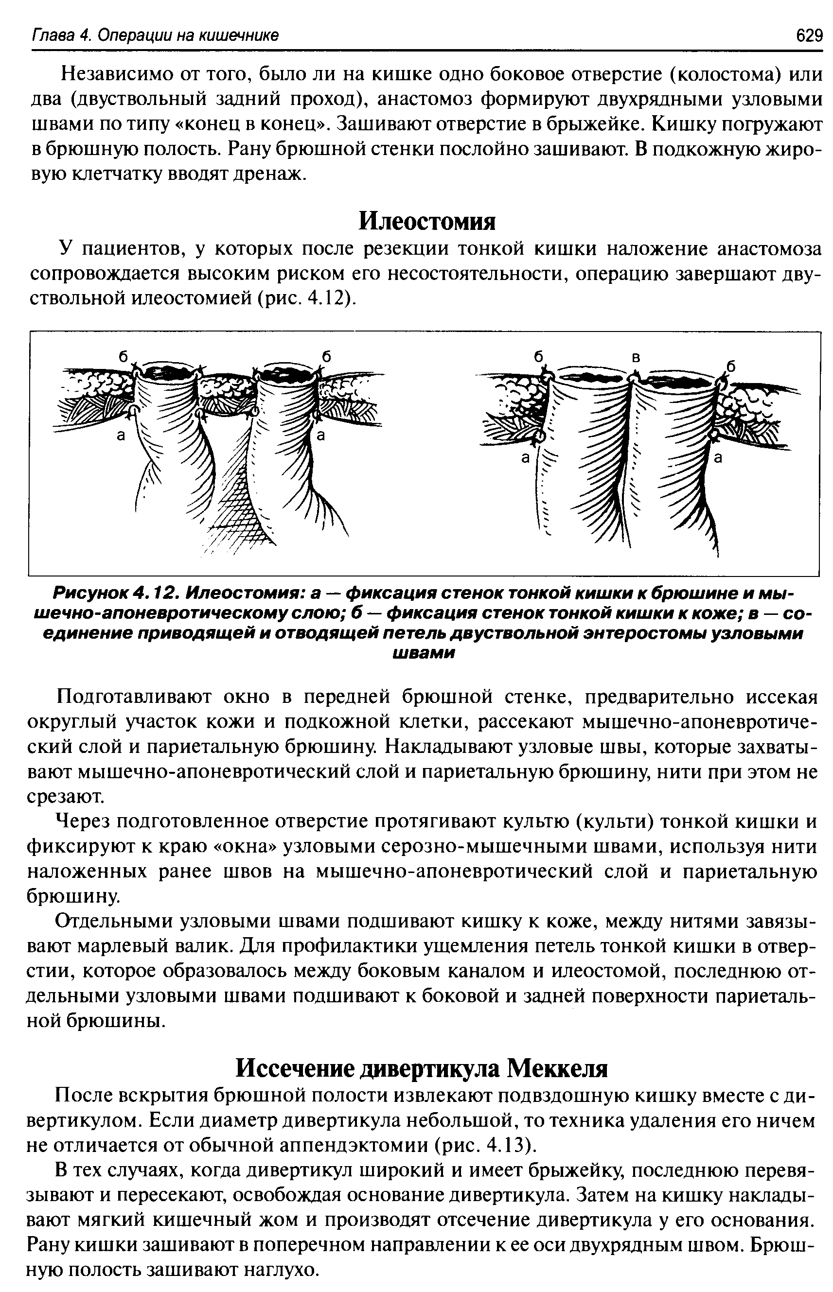 Рисунок 4.12. Илеостомия а — фиксация стенок тонкой кишки к брюшине и мышечно-апоневротическому слою б — фиксация стенок тонкой кишки к коже в — со единение приводящей и отводящей петель двуствольной энтеростомы узловыми швами...