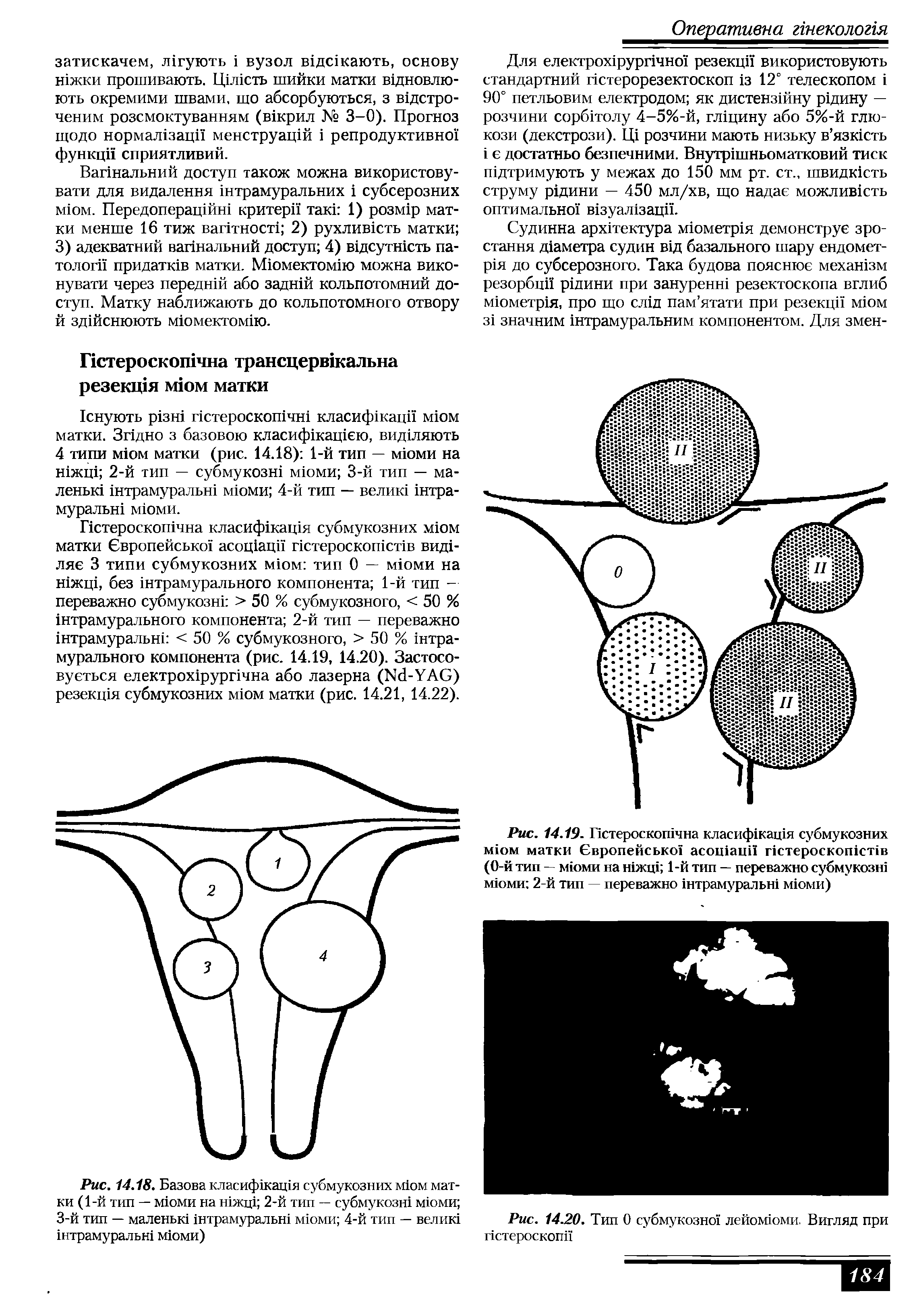 Рис. 14.19. Пстероскошчна класифшащя субмукозних мюм матки Бвропейсько асошацИ пстероскотспв (0-й тип — мюми на шжщ 1-й тип — переважно субмукозш мюми 2-й тип переважно нтрамуральш мюми)...