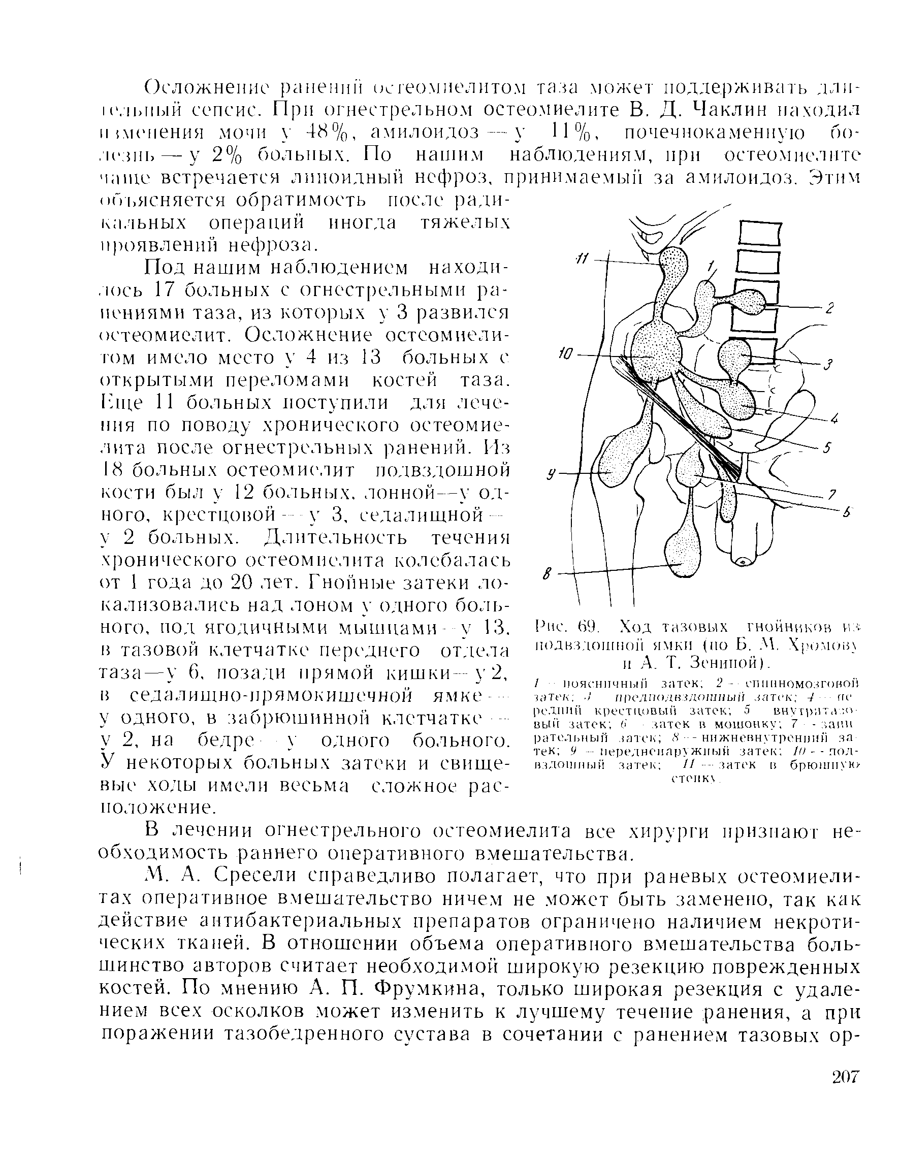 Рис. 69. Ход тазовых гнойников из подвздошной ямки (по Б. М. Хромов) и А. Т. Зенипой).