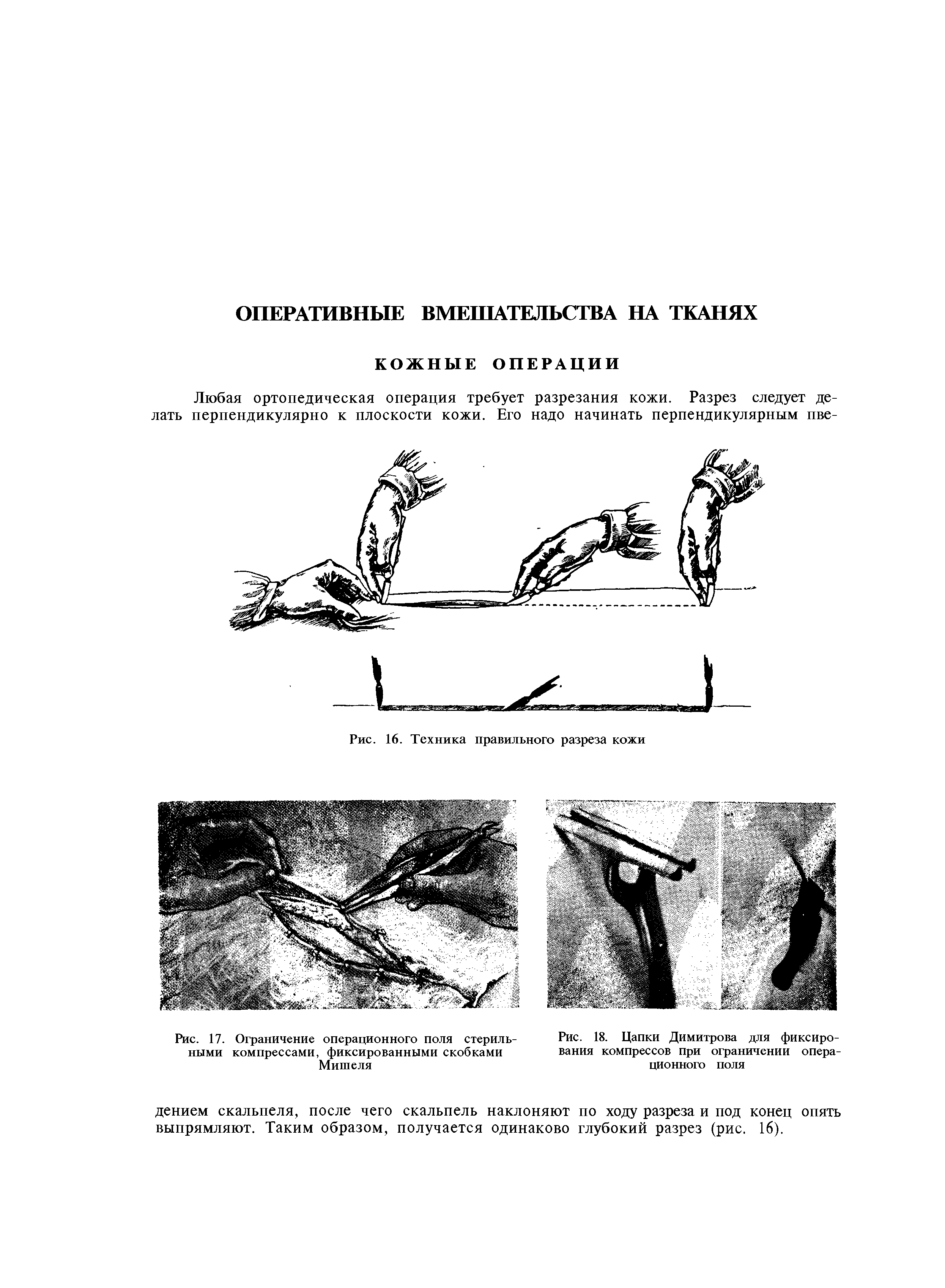 Рис. 17. Ограничение операционного поля стерильными компрессами, фиксированными скобками Мишеля...