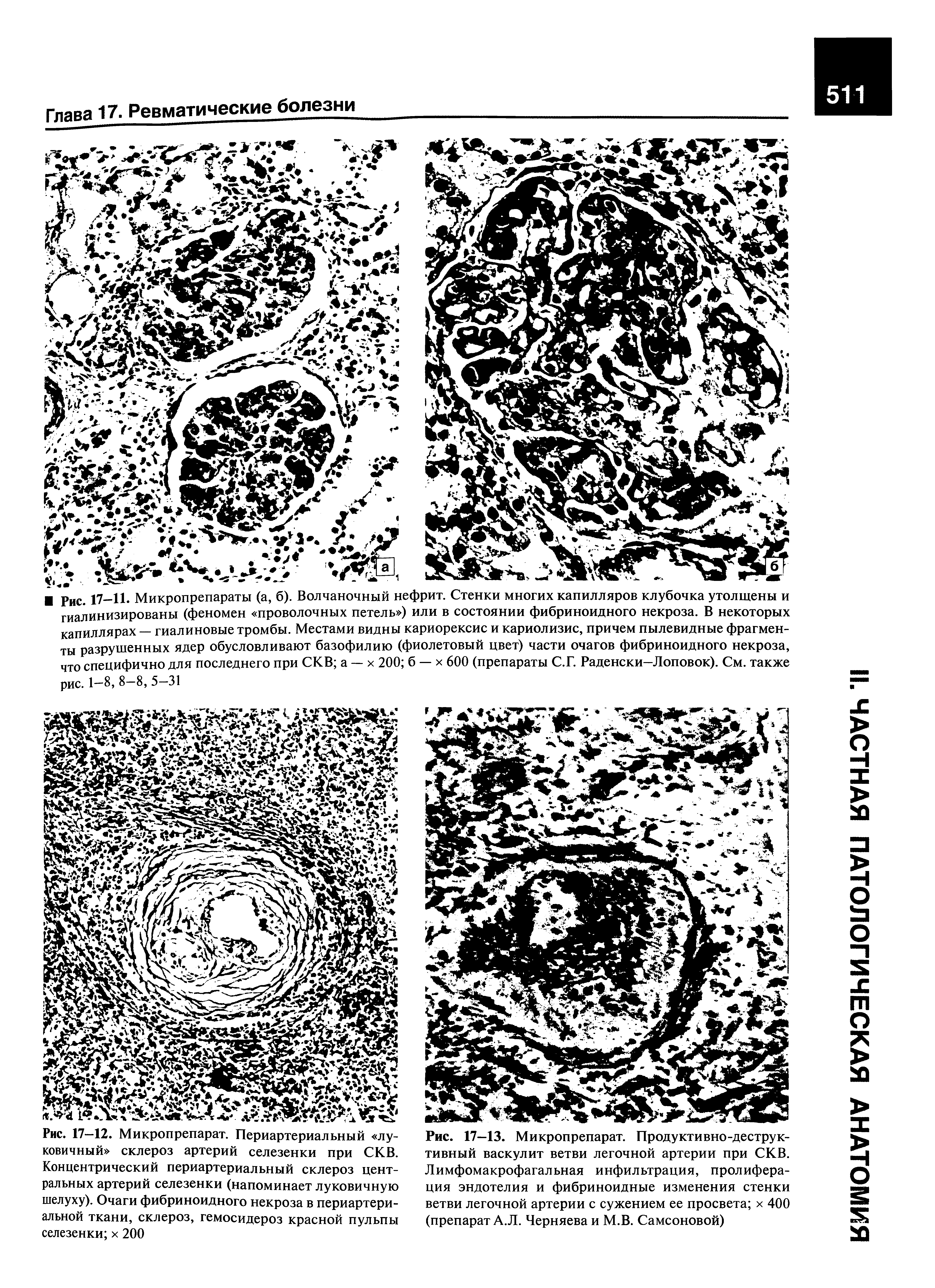 Рис. 17—13. Микропрепарат. Продуктивно-деструктивный васкулит ветви легочной артерии при СКВ. Лимфомакрофагальная инфильтрация, пролиферация эндотелия и фибриноидные изменения стенки ветви легочной артерии с сужением ее просвета х 400 (препарат А.Л. Черняева и М.В. Самсоновой)...