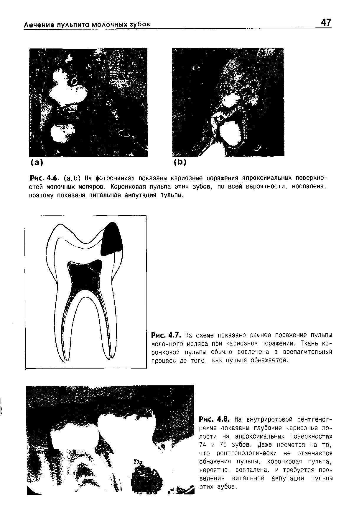 Рис. 4.8. На внутриротовой рентгенограмме показаны глубокие кариозные полости на апроксимальных поверхностях 74 и 75 зубов. Даже несмотря на то, что рентгенологически не отмечается обнажения пульпы, коронковая пульпа, вероятно, воспалена, и требуется проведения витальной ампутации пульпы этих зубов.