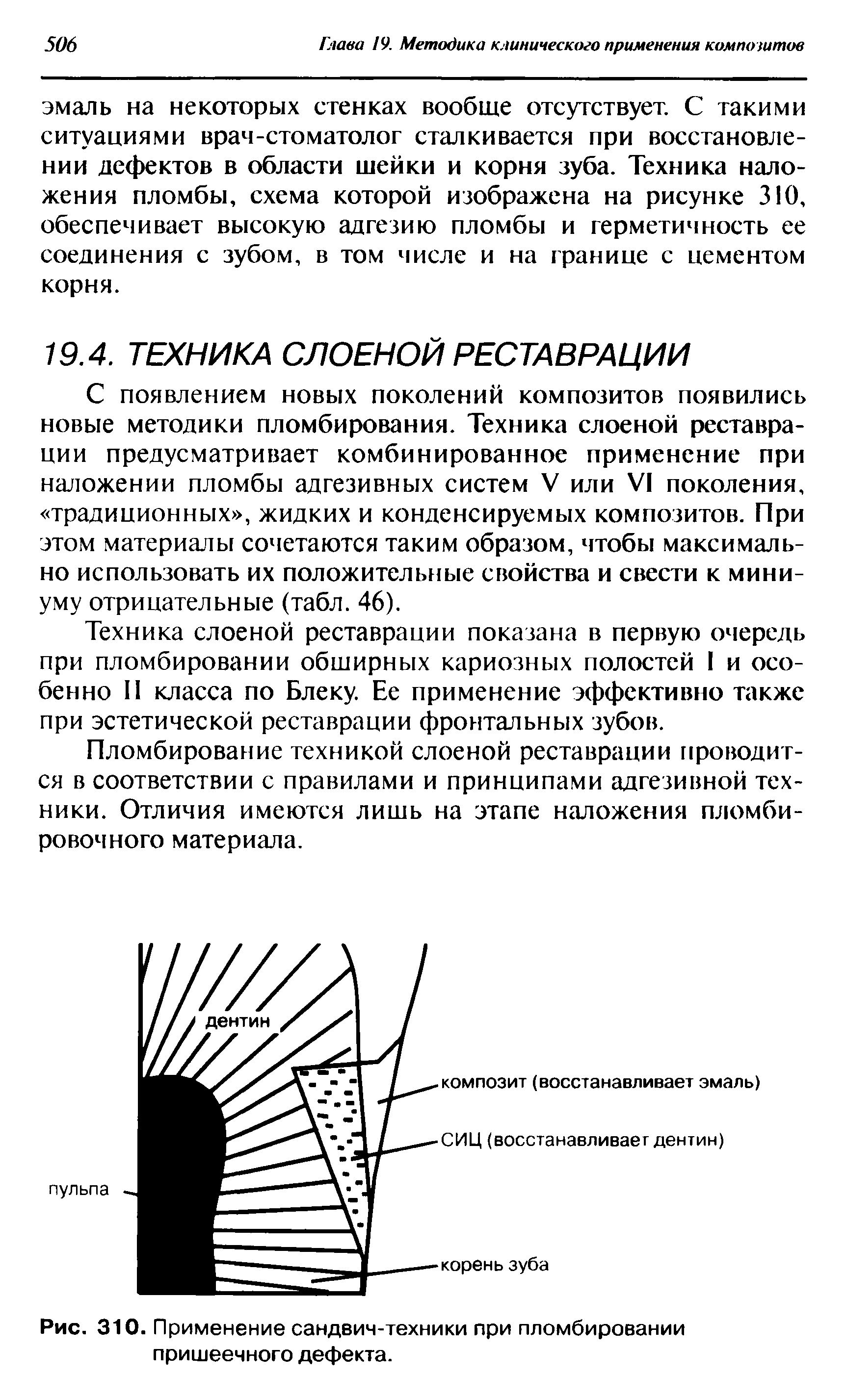 Рис. 310. Применение сандвич-техники при пломбировании пришеечного дефекта.