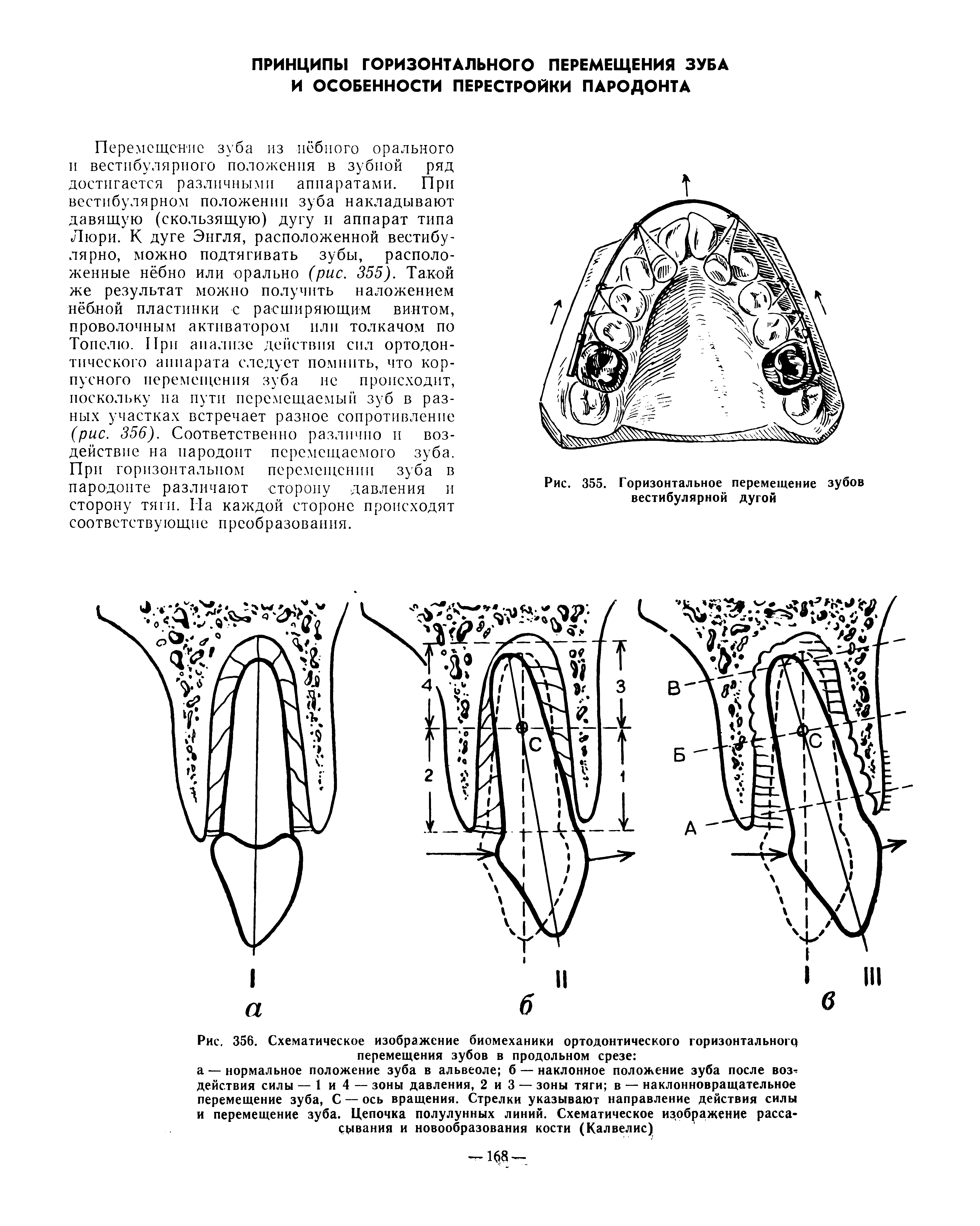 Рис. 356. Схематическое изображение биомеханики ортодонтического горизонтального перемещения зубов в продольном срезе ...