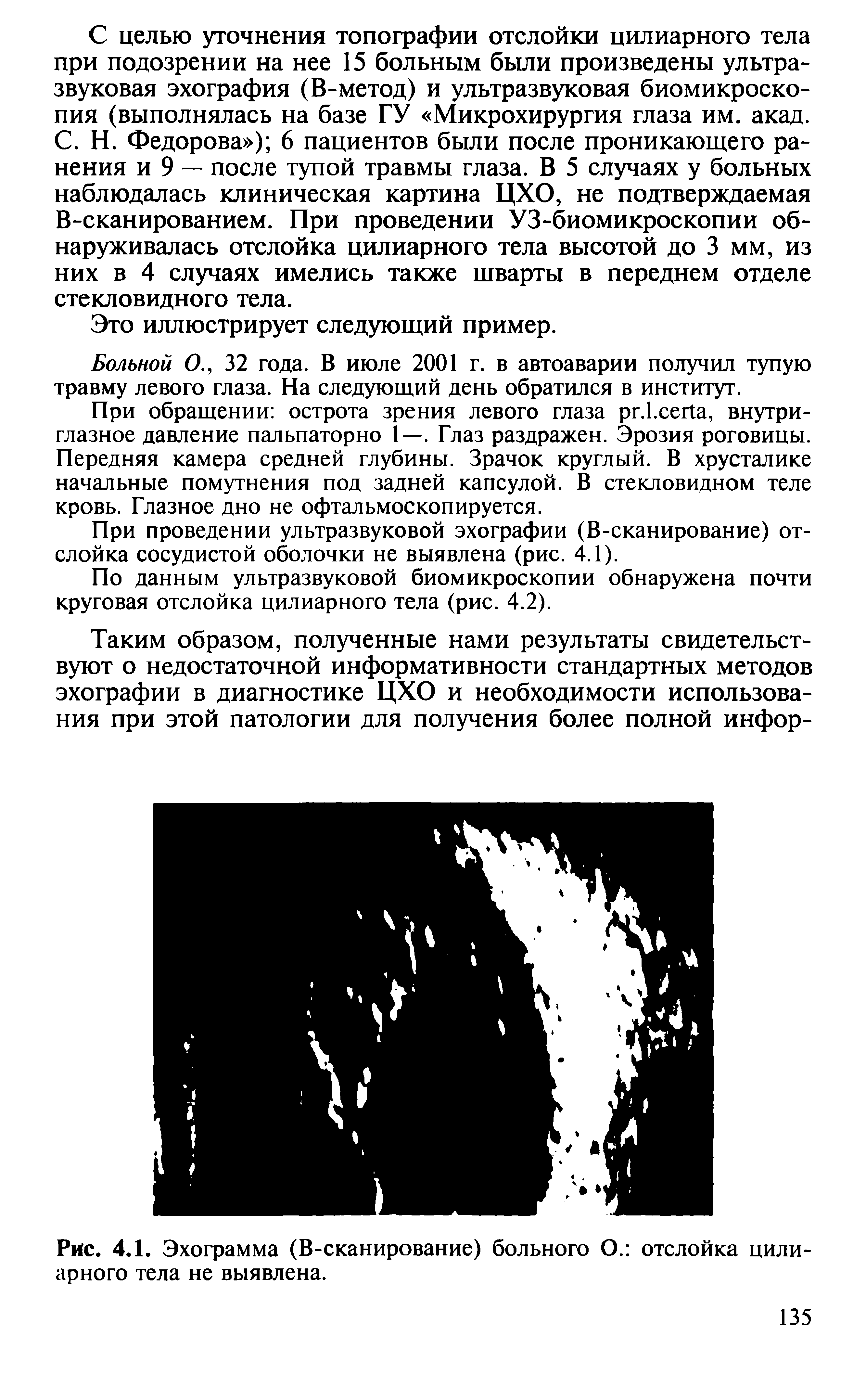 Рис. 4.1. Эхограмма (В-сканирование) больного О. отслойка цилиарного тела не выявлена.