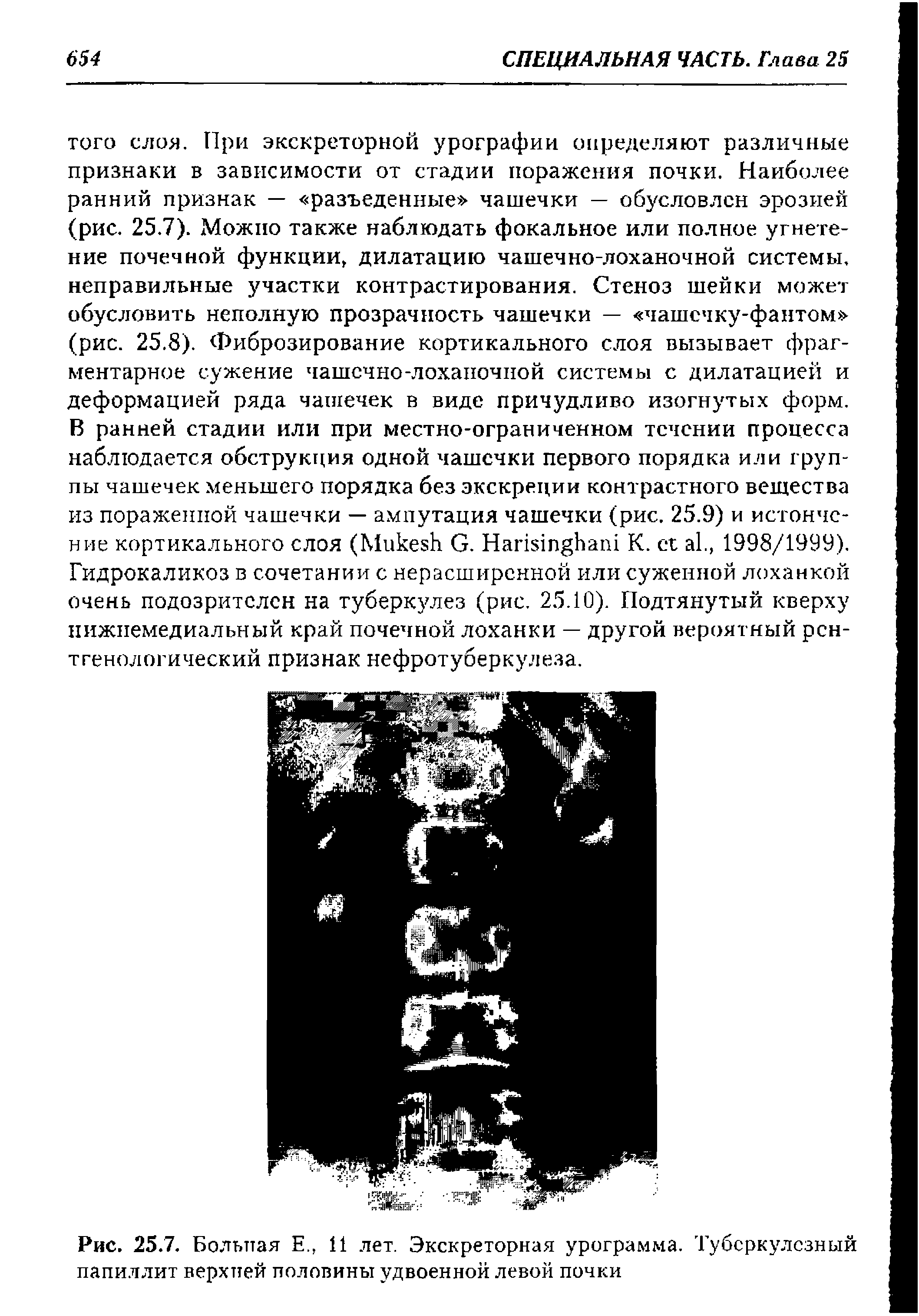 Рис. 25.7. Больная Е., 11 лет. Экскреторная урограмма. Туберкулезный папиллит верхней половины удвоенной левой почки...