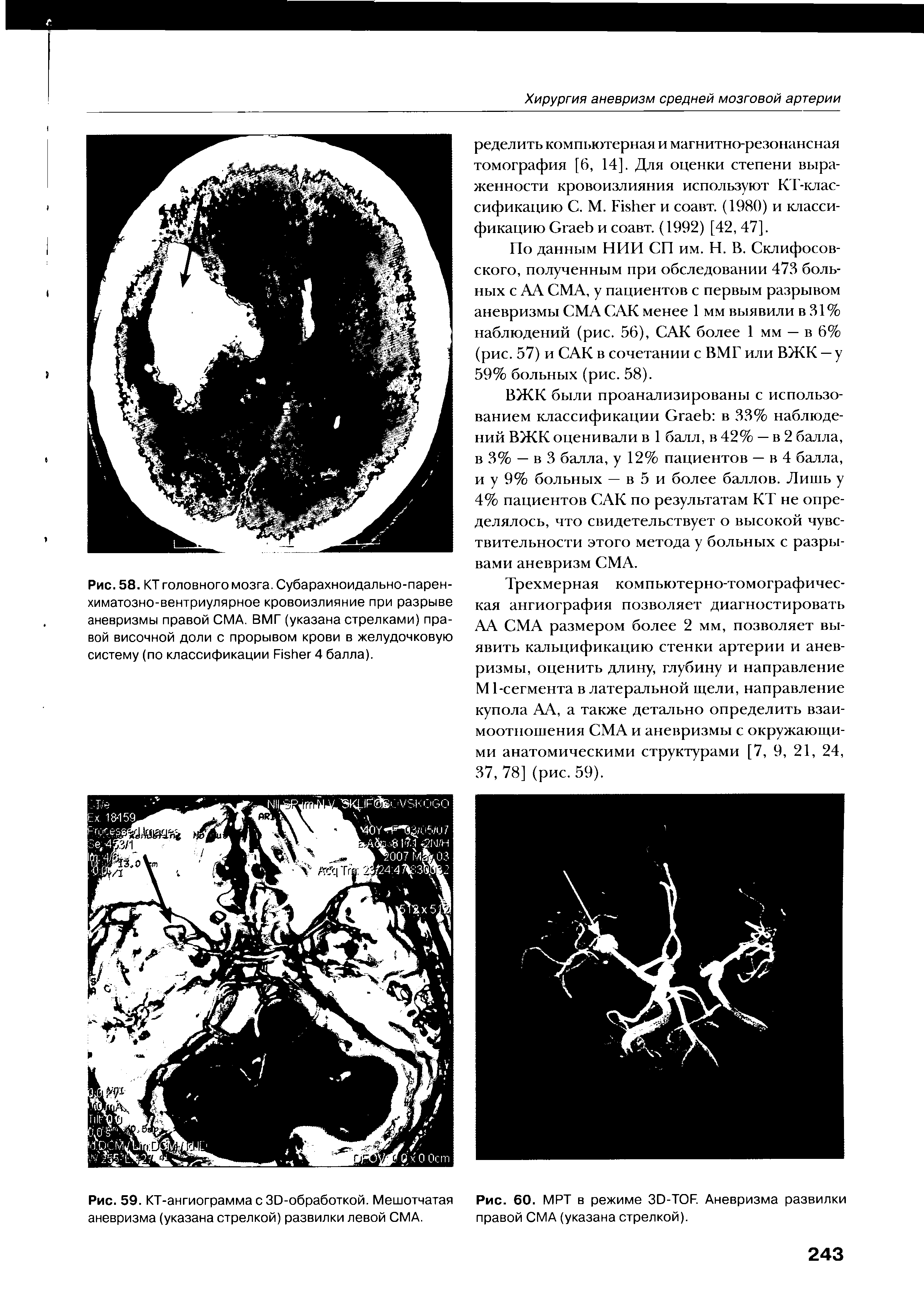 Рис. 59. КТ-ангиограмма с ЗО-обработкой. Мешотчатая аневризма (указана стрелкой) развилки левой СМА.