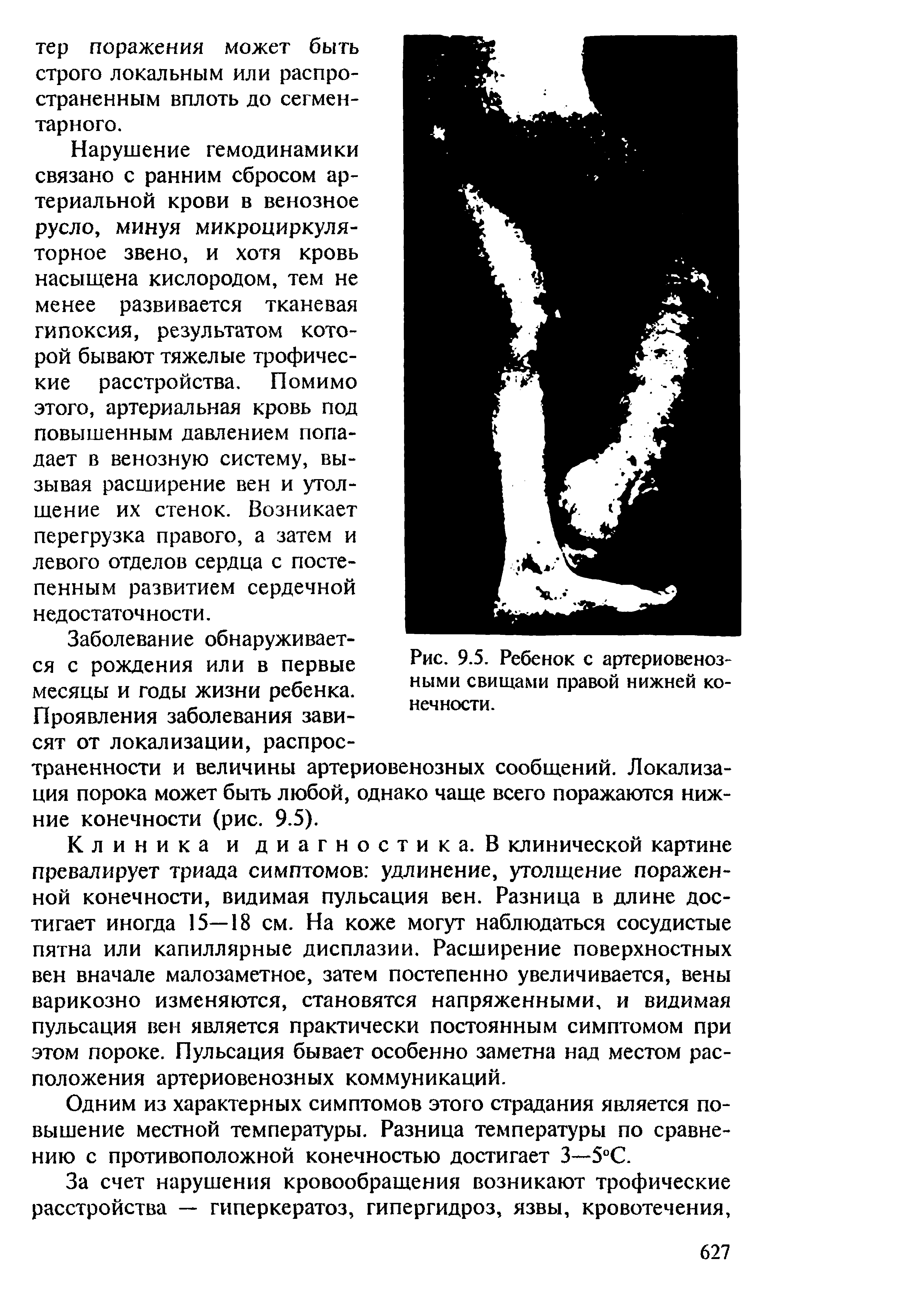 Рис. 9.5. Ребенок с артериовенозными свищами правой нижней конечности.