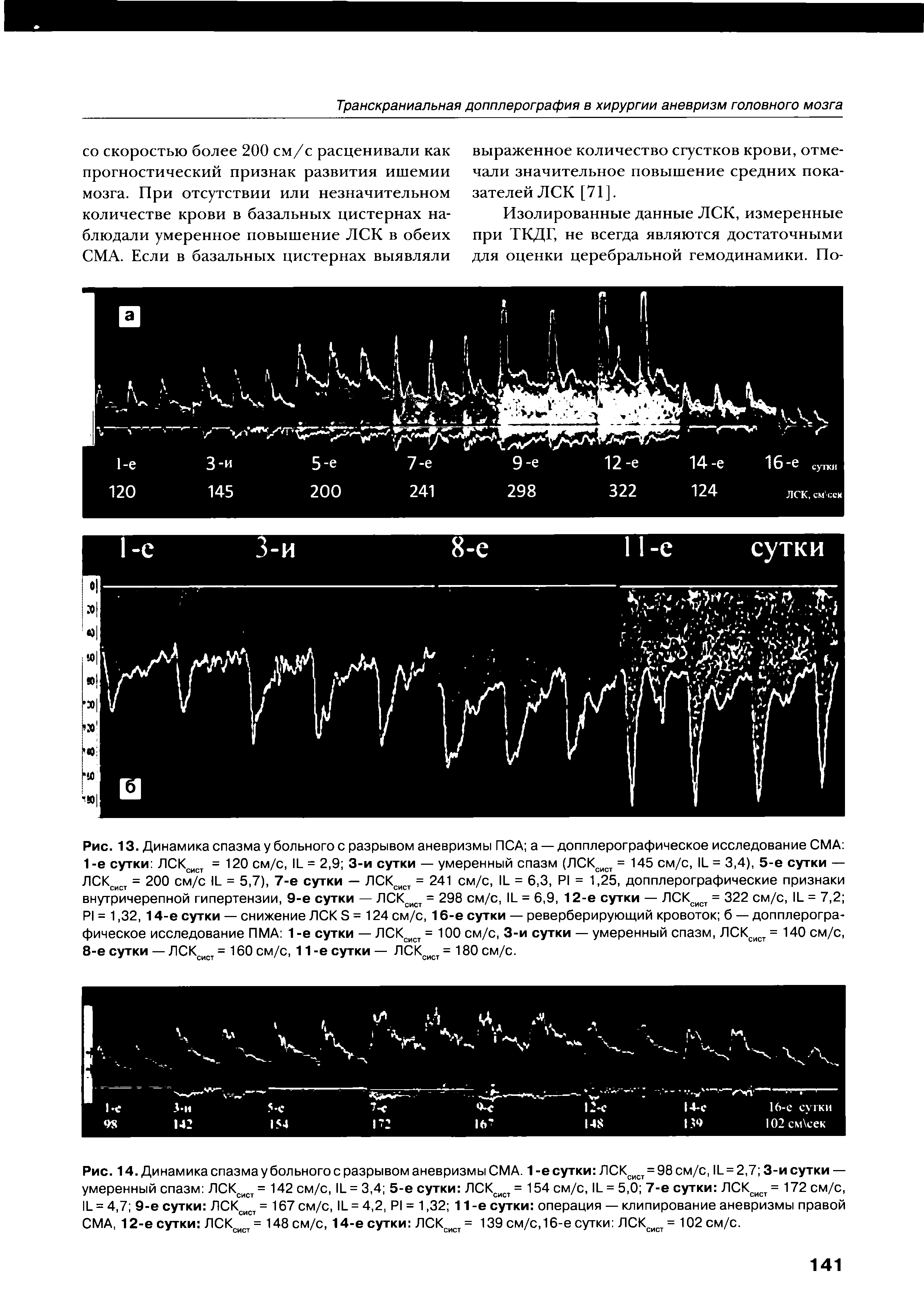 Рис. 13. Динамика спазма у больного с разрывом аневризмы ПСА а — допплерографическое исследование СМА 1 -е сутки ЛСКсист = 120 см/с, II. = 2,9 3-и сутки — умеренный спазм (ЛСКсист = 145 см/с, II. = 3,4), 5-е сутки — ЛСКсист = 200 см/с II- = 5,7), 7-е сутки — ЛСКсист = 241 см/с, И = 6,3, Р1 = 1,25, допплерографические признаки внутричерепной гипертензии, 9-е сутки — ЛСКсист = 298 см/с, II. = 6,9, 12-е сутки — ЛСКсист = 322 см/с, II- = 7,2 Р1 = 1,32, 14-е сутки — снижение ЛСК Э = 124 см/с, 16-е сутки — реверберирующий кровоток б — допплерографическое исследование ПМА 1 -е сутки — ЛСКсист = 100 см/с, 3-и сутки — умеренный спазм, ЛСКсист = 140 см/с, 8-е сутки — ЛСКсист = 160 см/с, 11-е сутки — ЛСКсист = 180 см/с.