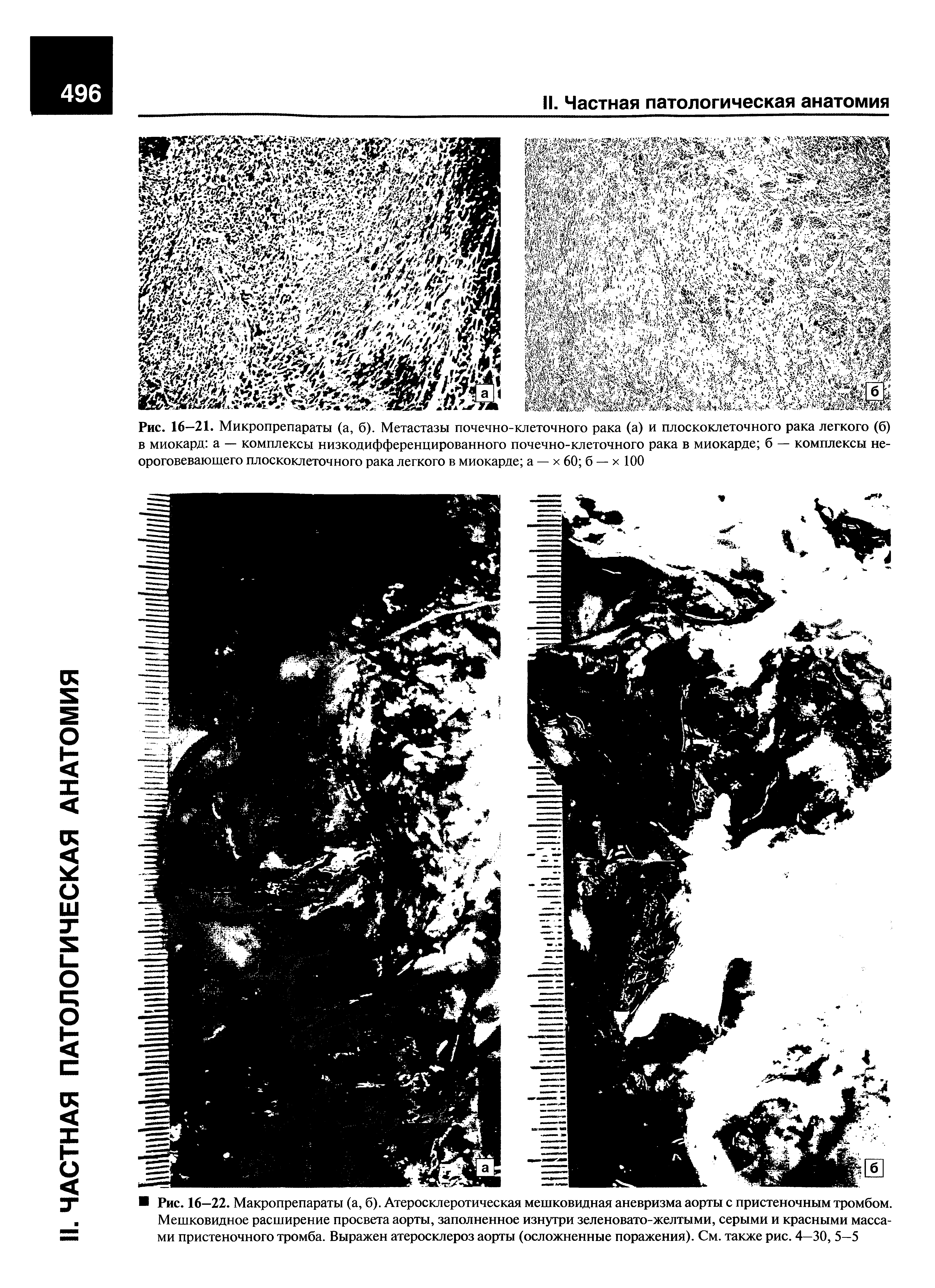 Рис. 16—21. Микропрепараты (а, б). Метастазы почечно-клеточного рака (а) и плоскоклеточного рака легкого (б) в миокард а — комплексы низкодифференцированного почечно-клеточного рака в миокарде б — комплексы не-ороговевающего плоскоклеточного рака легкого в миокарде а — х 60 б — х 100...