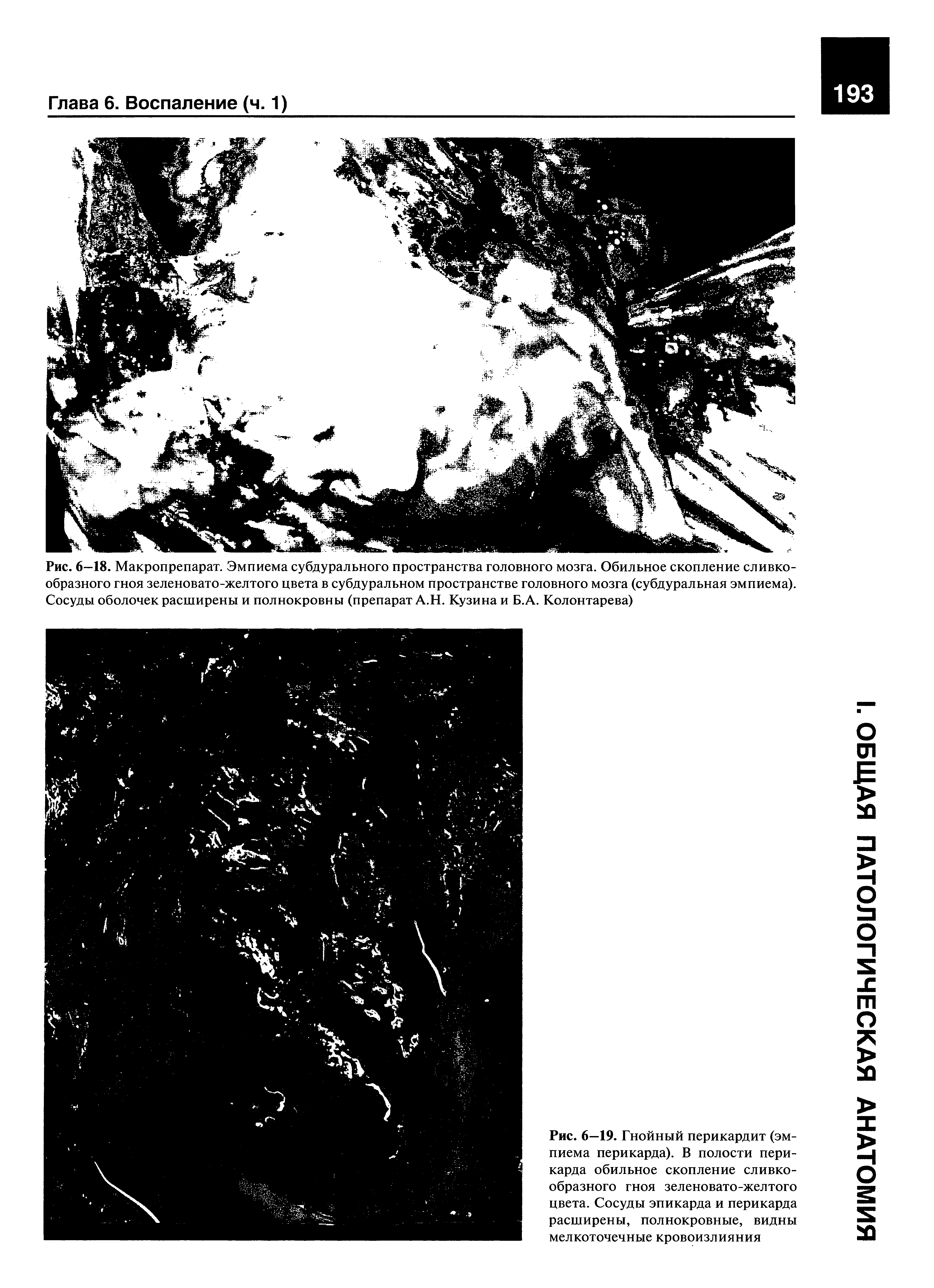 Рис. 6—19. Гнойный перикардит (эмпиема перикарда). В полости перикарда обильное скопление сливкообразного гноя зеленовато-желтого цвета. Сосуды эпикарда и перикарда расширены, полнокровные, видны мелкоточечные кровоизлияния...