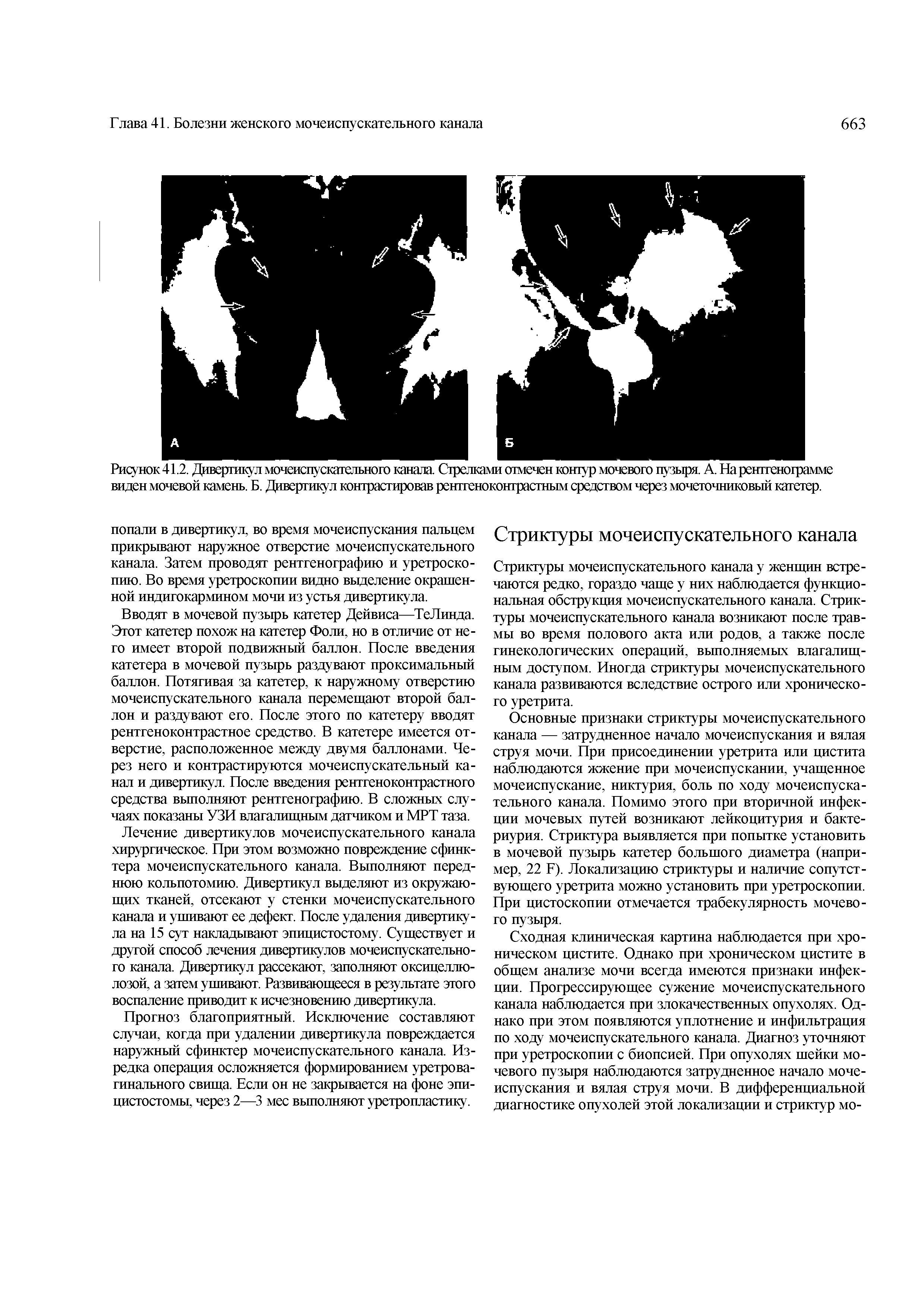 Рисунок 41.2. Дивертикул мочеиспускательного канала. Стрелками отмечен контур мочевого пузыря. А. На рентгенограмме виден мочевой камень. Б. Дивертикул контрастировав рентгеноконтрастным средством через мочеточниковый катетер.