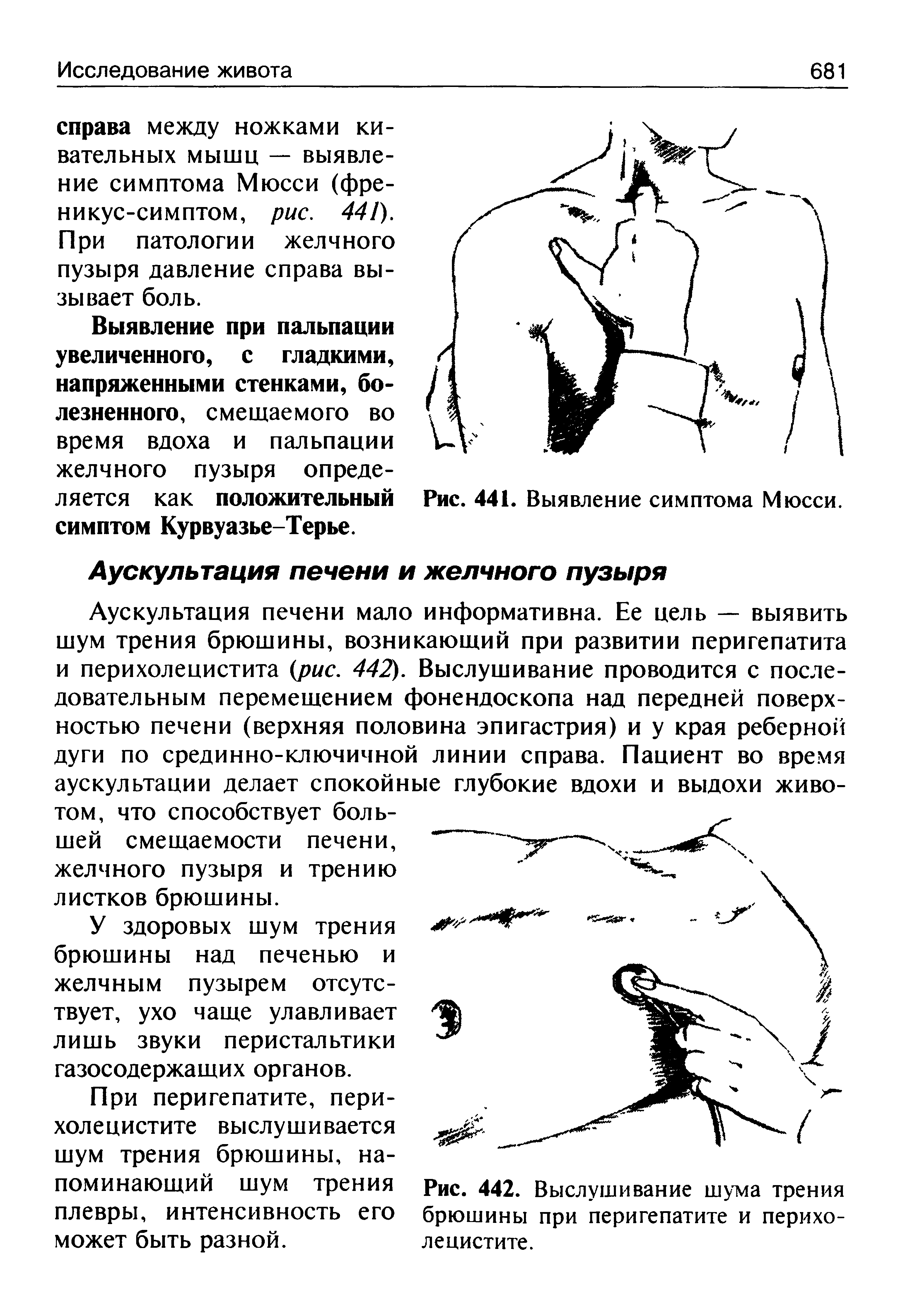 Рис. 442. Выслушивание шума трения брюшины при перигепатите и перихолецистите.