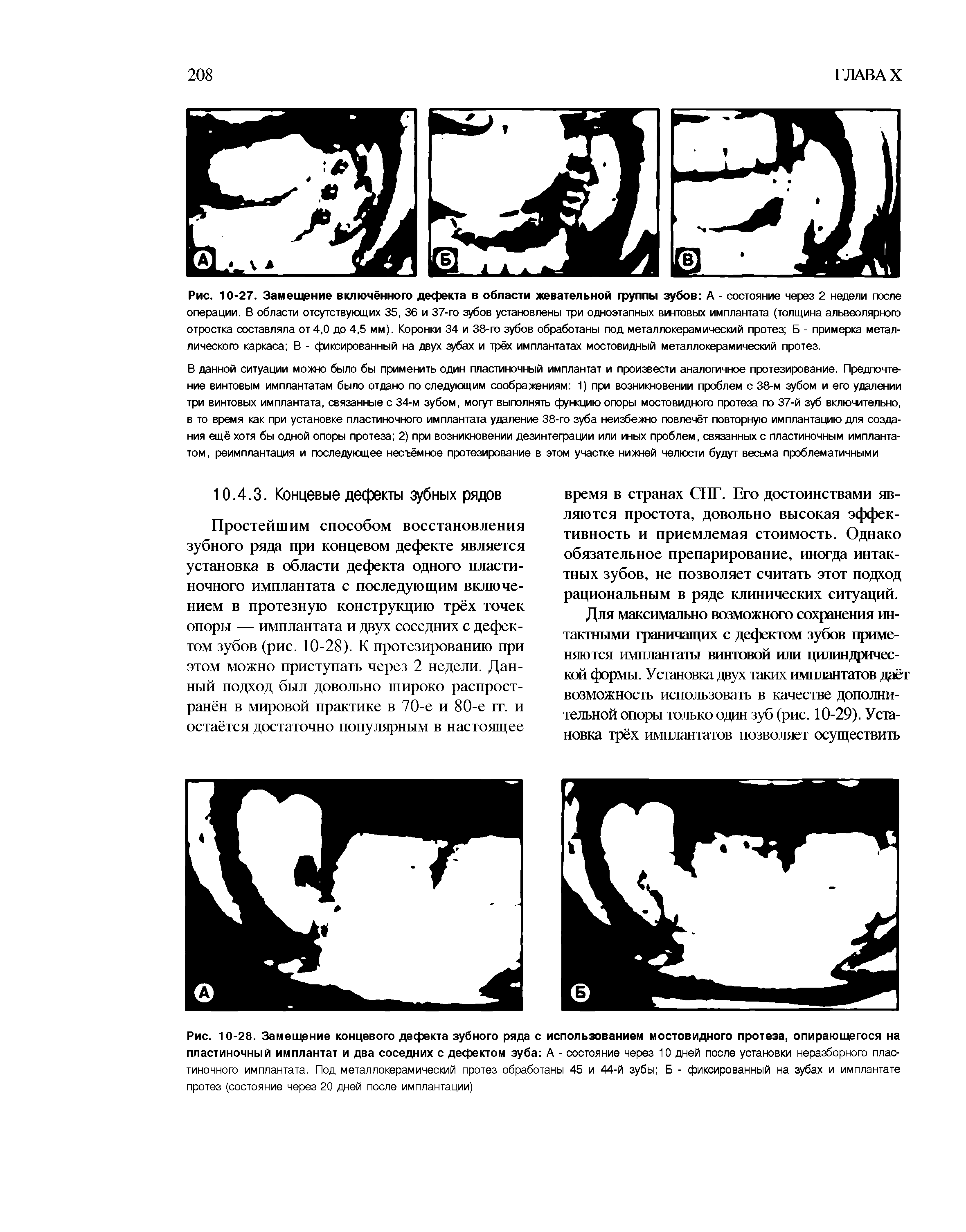 Рис. 10-28. Замещение концевого дефекта зубного ряда с использованием мостовидного протеза, опирающегося на пластиночный имплантат и два соседних с дефектом зуба А - состояние через 10 дней после установки неразборного пластиночного имплантата. Под металлокерамический протез обработаны 45 и 44-й зубы Б - фиксированный на зубах и имплантате протез (состояние через 20 дней после имплантации)...