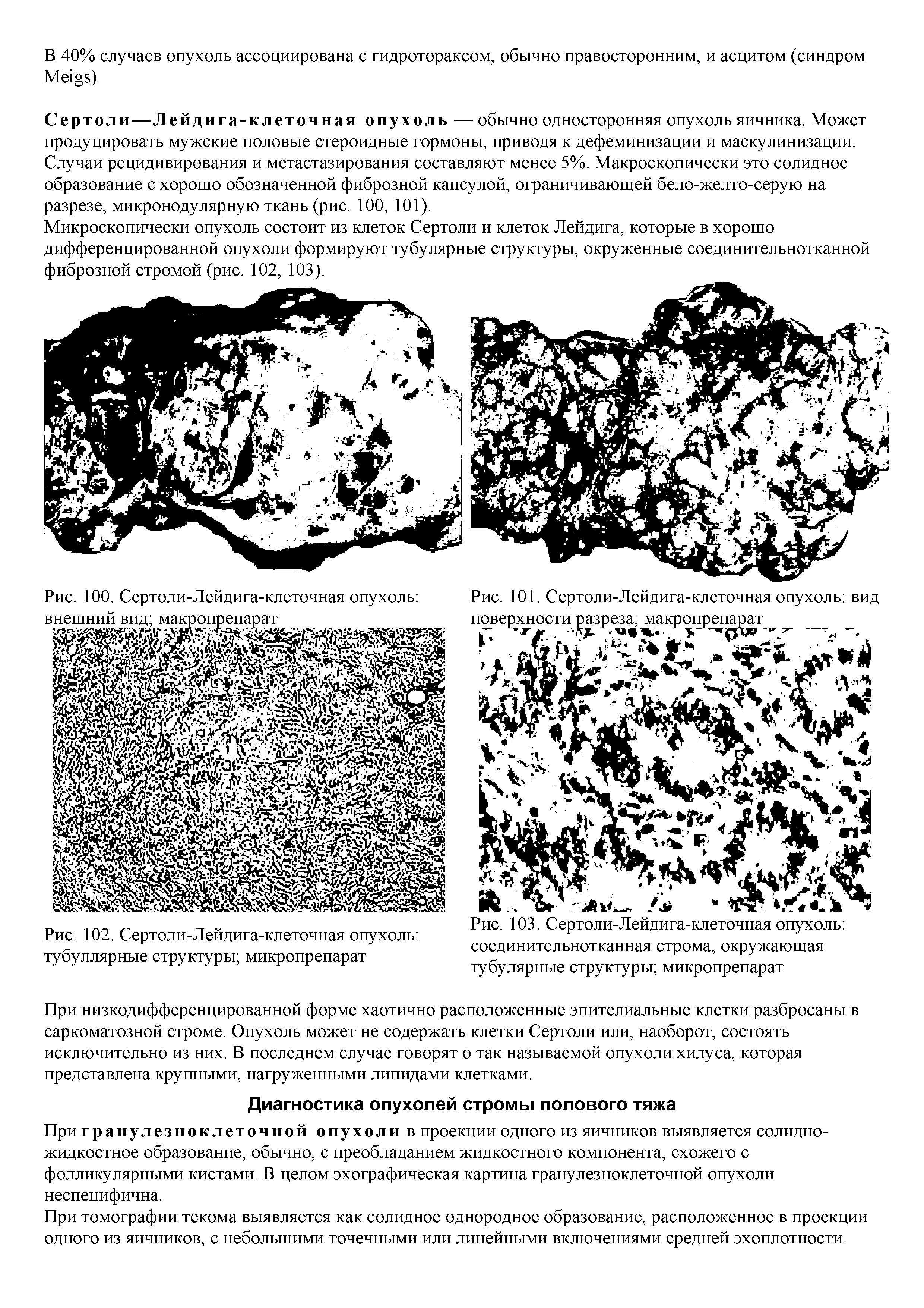 Рис. 102. Сертоли-Лейдига-клеточная опухоль тубуллярные структуры микропрепарат...